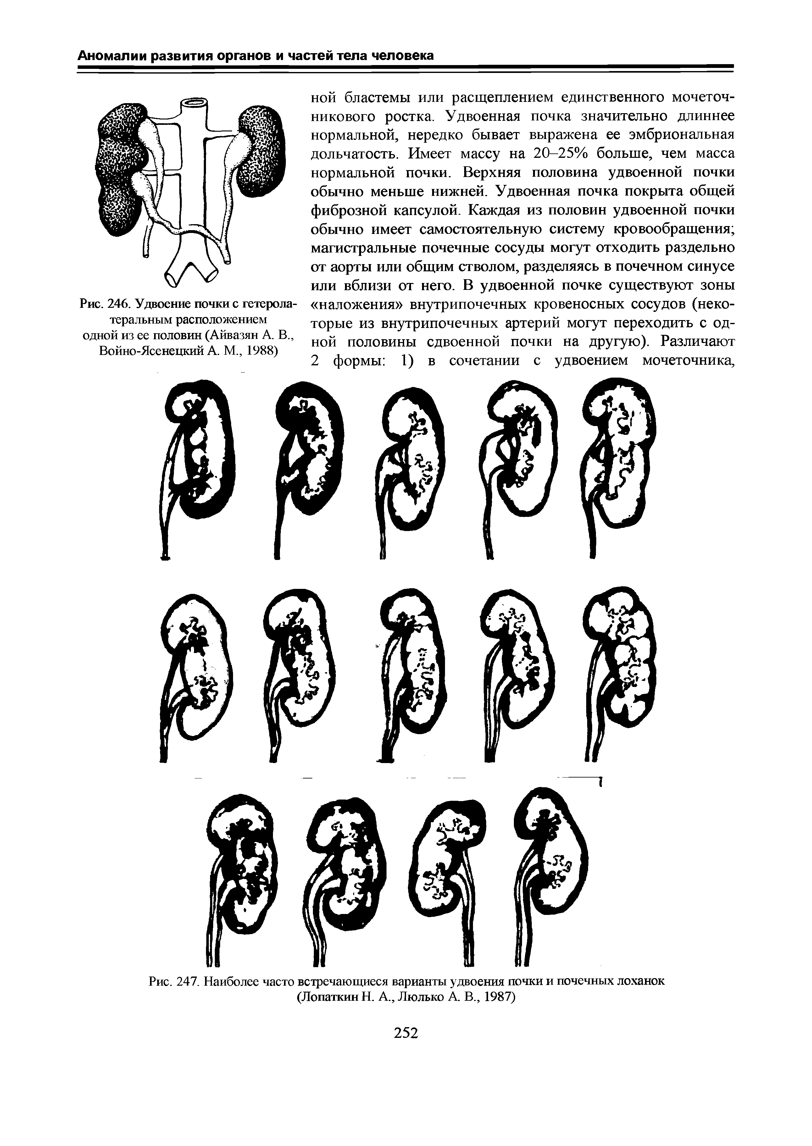 Рис. 247. Наиболее часто встречающиеся варианты удвоения почки и почечных лоханок...