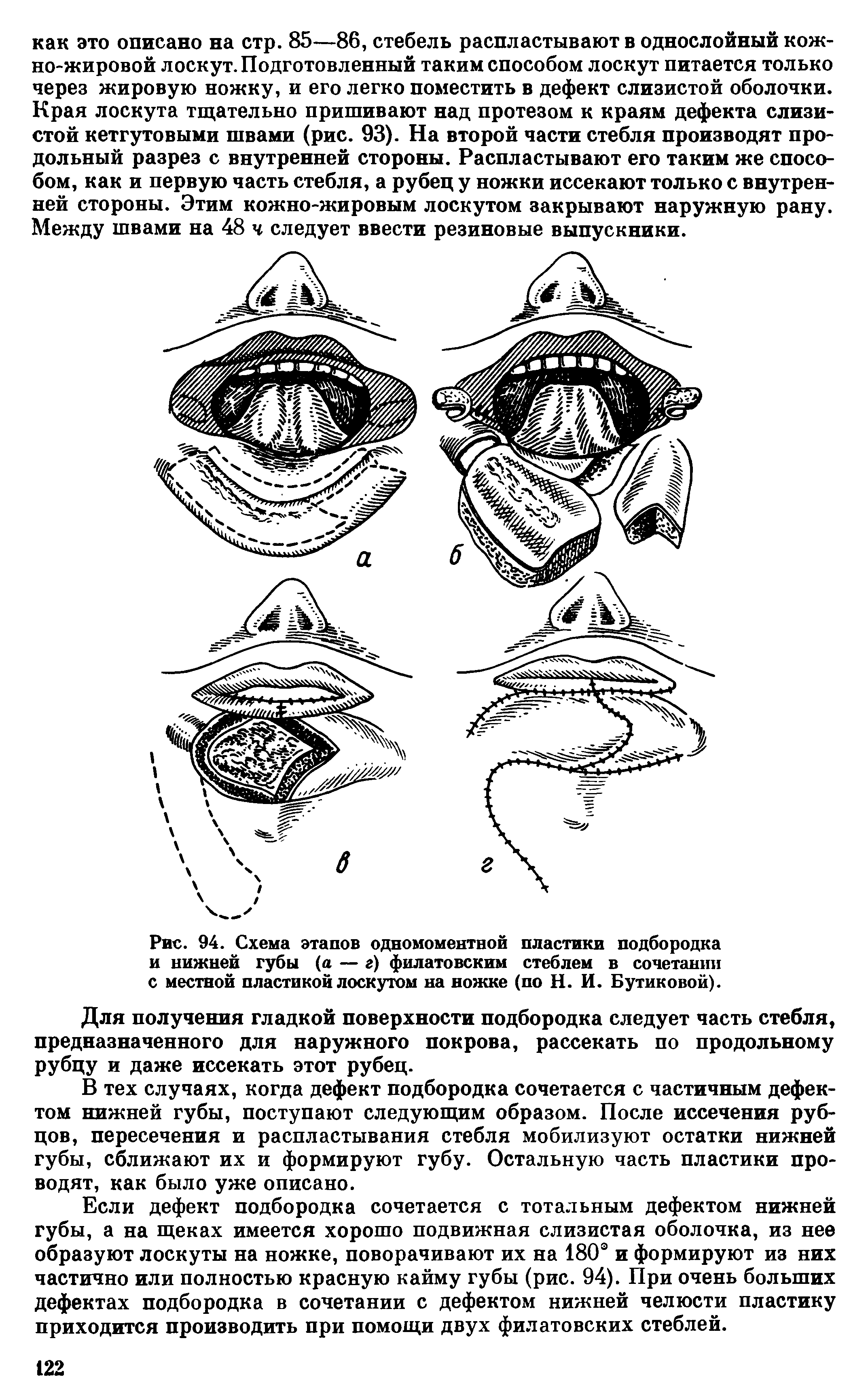 Рис. 94. Схема этапов одномоментной пластики подбородка и нижней губы (а — г) филатовским стеблем в сочетании с местной пластикой лоскутом на ножке (по Н. И. Бутиковой).