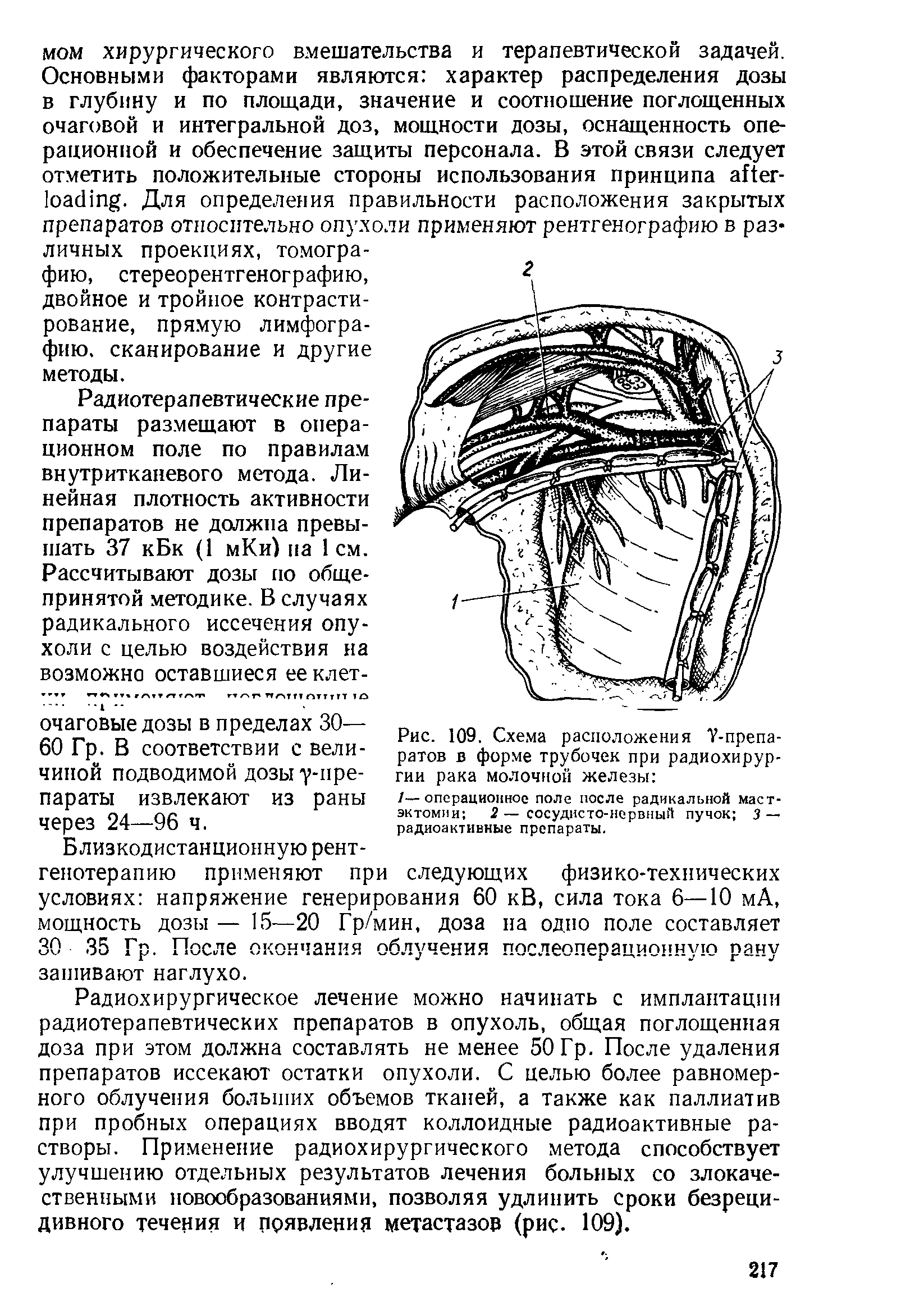 Рис. 109. Схема расположения 7-препаратов в форме трубочек при радиохирургии рака молочной железы ...