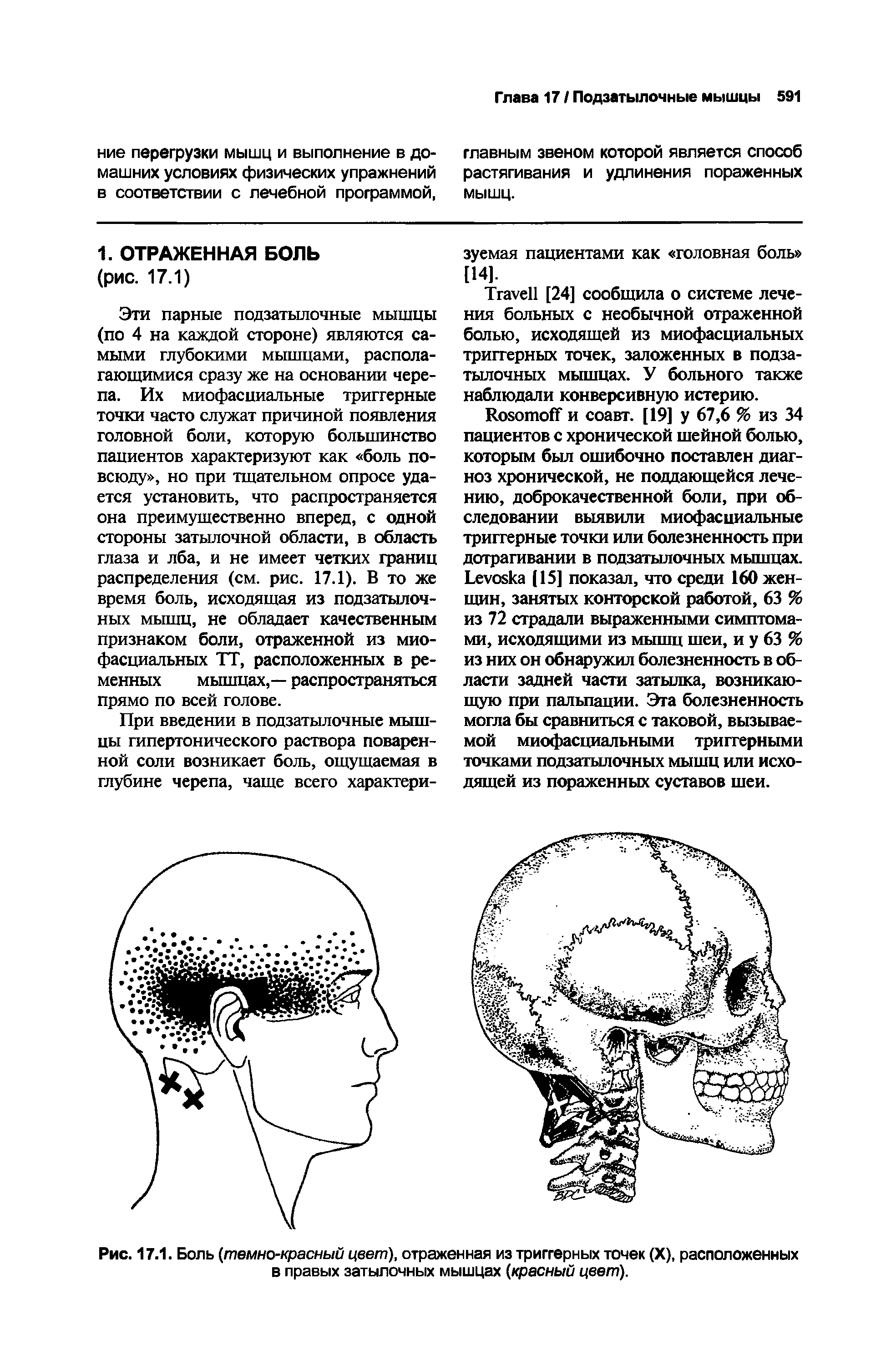 Рис. 17.1. Боль (темно-красный цвет), отраженная из триггерных точек (X), расположенных в правых затылочных мышцах (красный цвет).