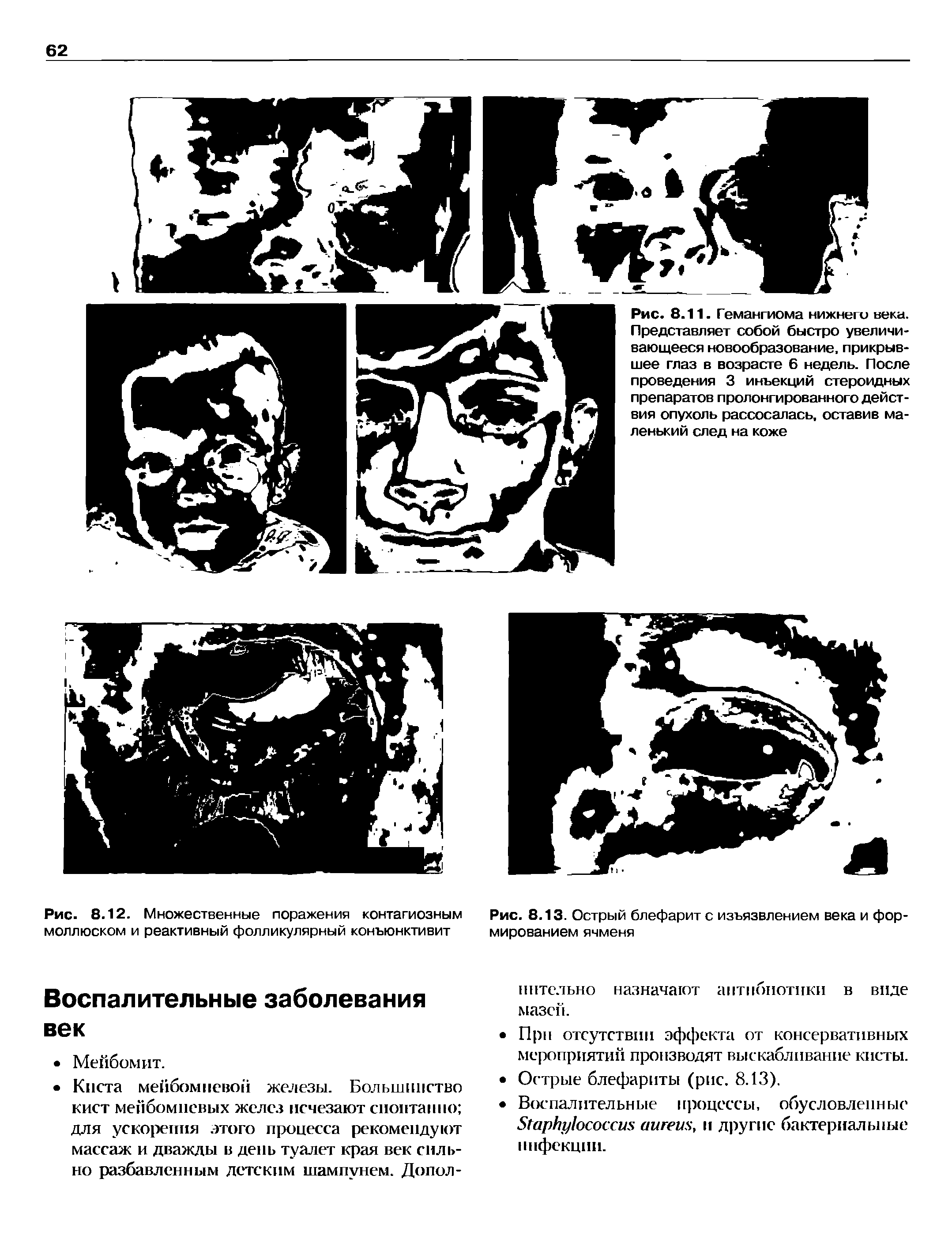 Рис. 8.12. Множественные поражения контагиозным моллюском и реактивный фолликулярный конъюнктивит...