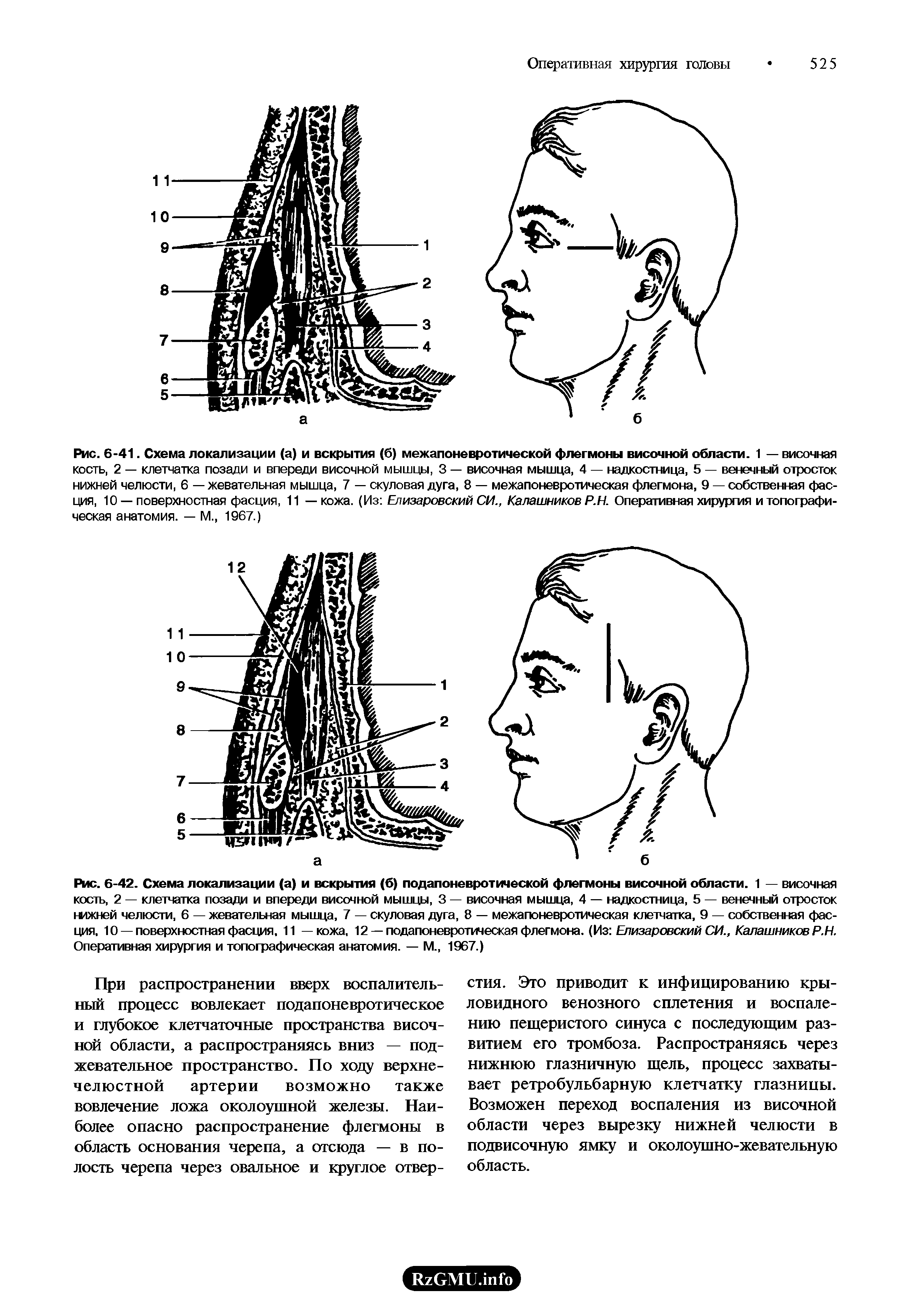 Рис. 6-41. Схема локализации (а) и вскрытия (6) межапоневротической флегмоны височной области. 1 — височная кость, 2 — клетчатка позади и впереди височной мышцы, 3 — височная мышца, 4 — надкостница, 5 — венечный отросток нижней челюсти, 6 — жевательная мышца, 7 — скуловая дуга, 8 — межапоневротическая флегмона, 9 — собственная фасция, 10 — поверхностная фасция, 11 — кожа. (Из Елизаровский СИ., Калашников Р.Н. Оперативная хирургия и топографическая анатомия. — М., 1967.)...