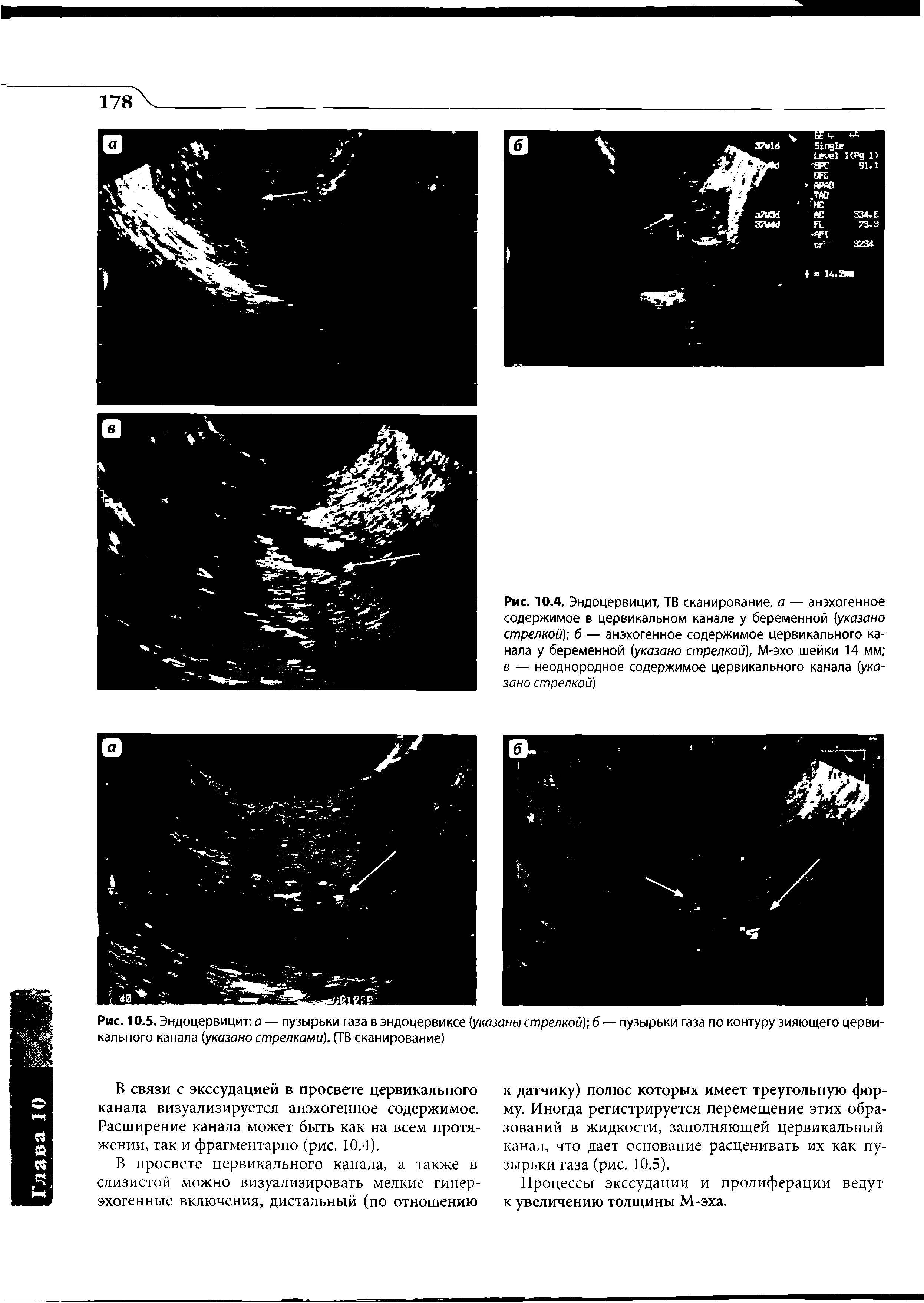 Рис. 10.5. Эндоцервицит а — пузырьки газа в эндоцервиксе (указаны стрелкой) б — пузырьки газа по контуру зияющего цервикального канала (указано стрелками). (ТВ сканирование)...