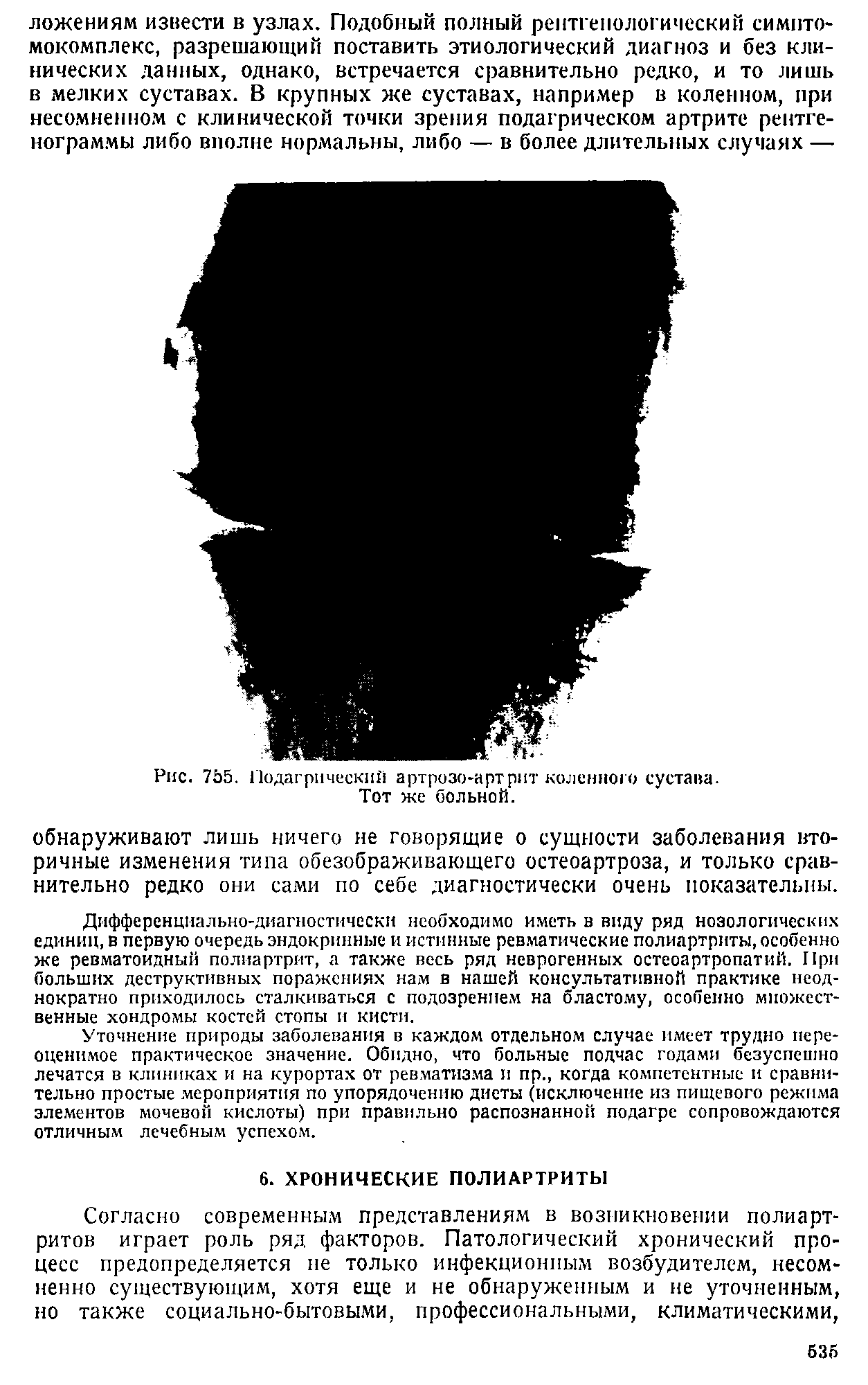 Рис. 7Ь5. Подагрический артрозо-артрит коленного сустава. Тот же больной.