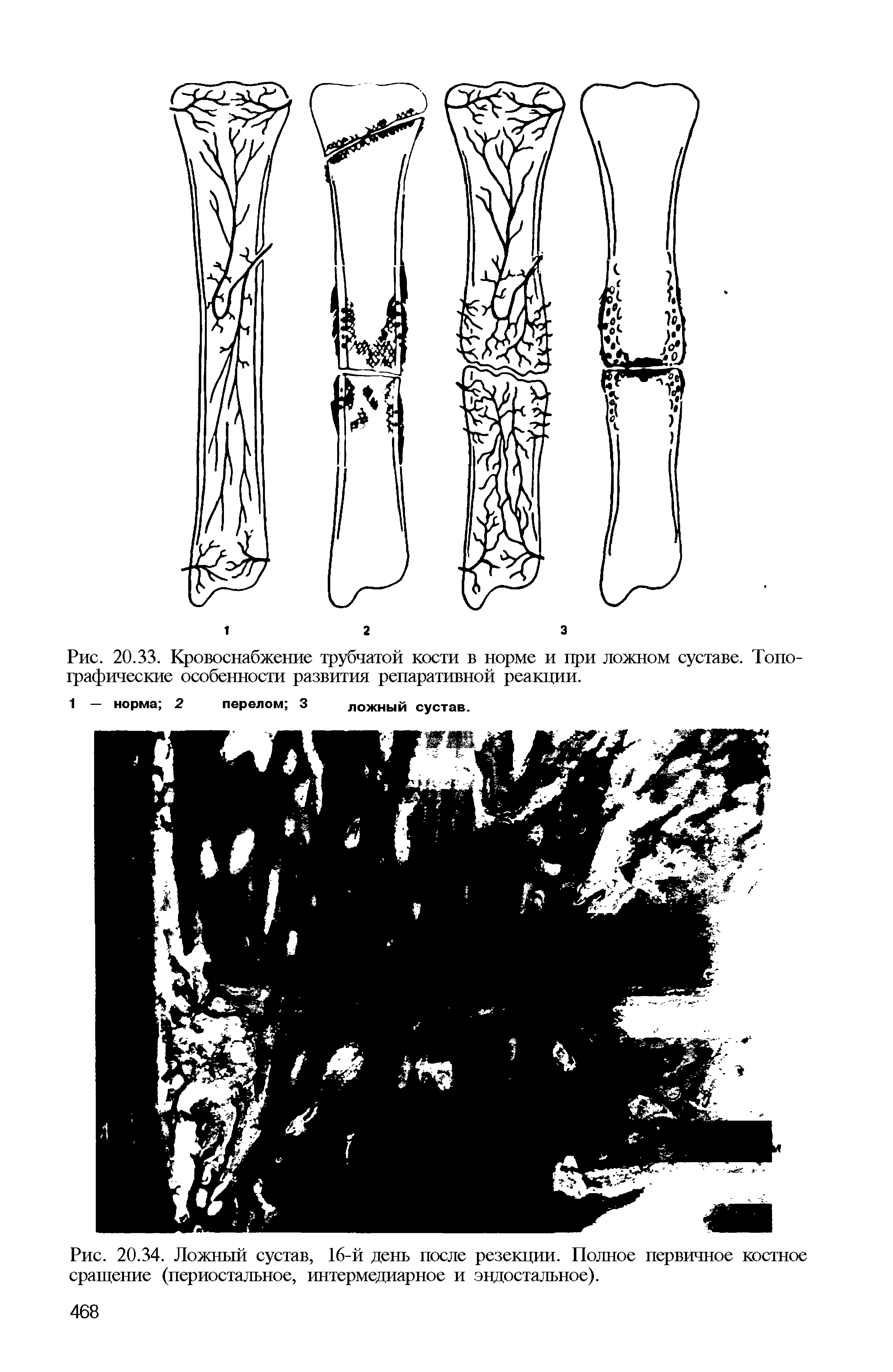 Рис. 20.33. Кровоснабжение трубчатой кости в норме и при ложном суставе. Топографические особенности развития репаративной реакции.