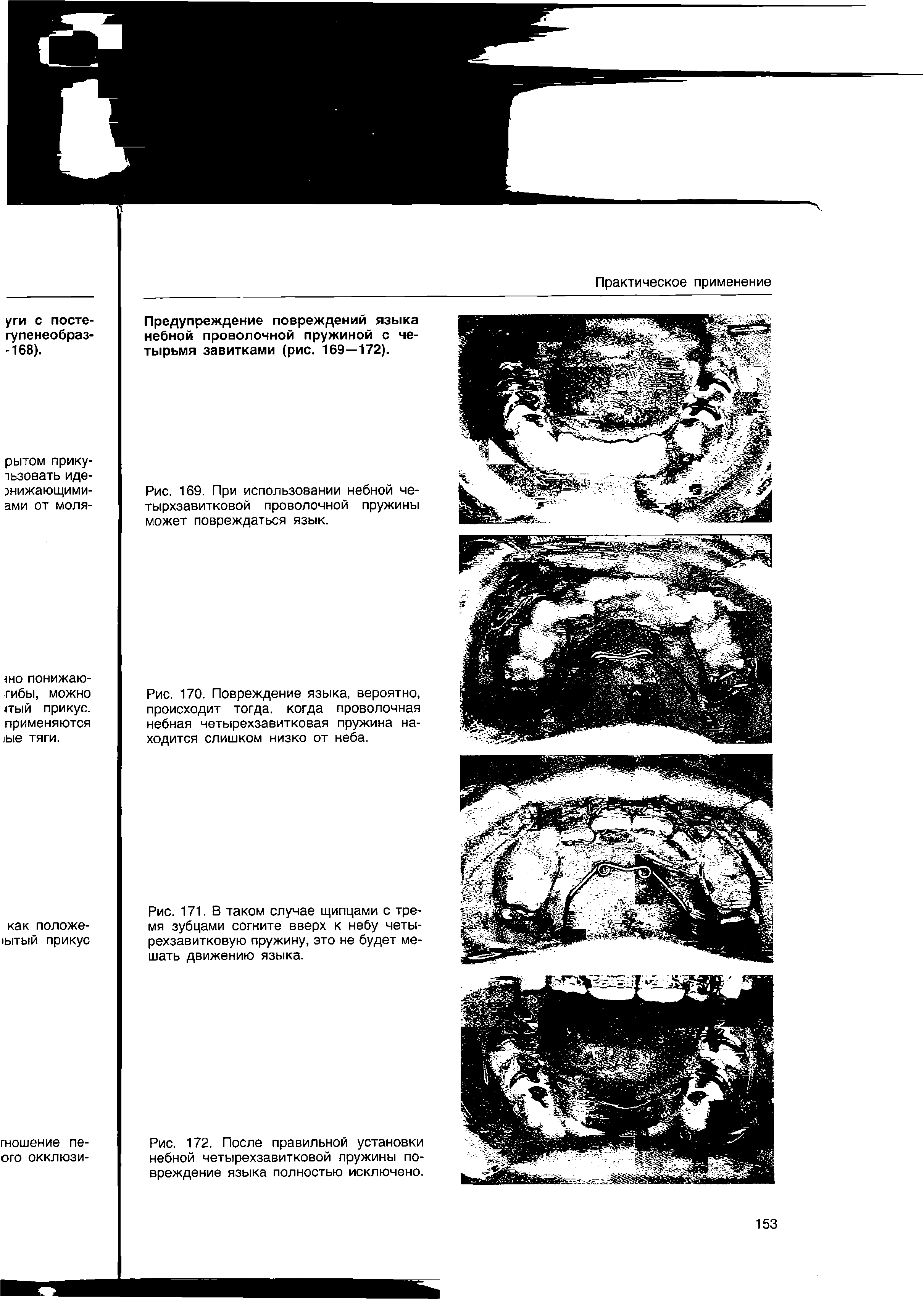 Рис. 170. Повреждение языка, вероятно, происходит тогда, когда проволочная небная четырехзавитковая пружина находится слишком низко от неба.