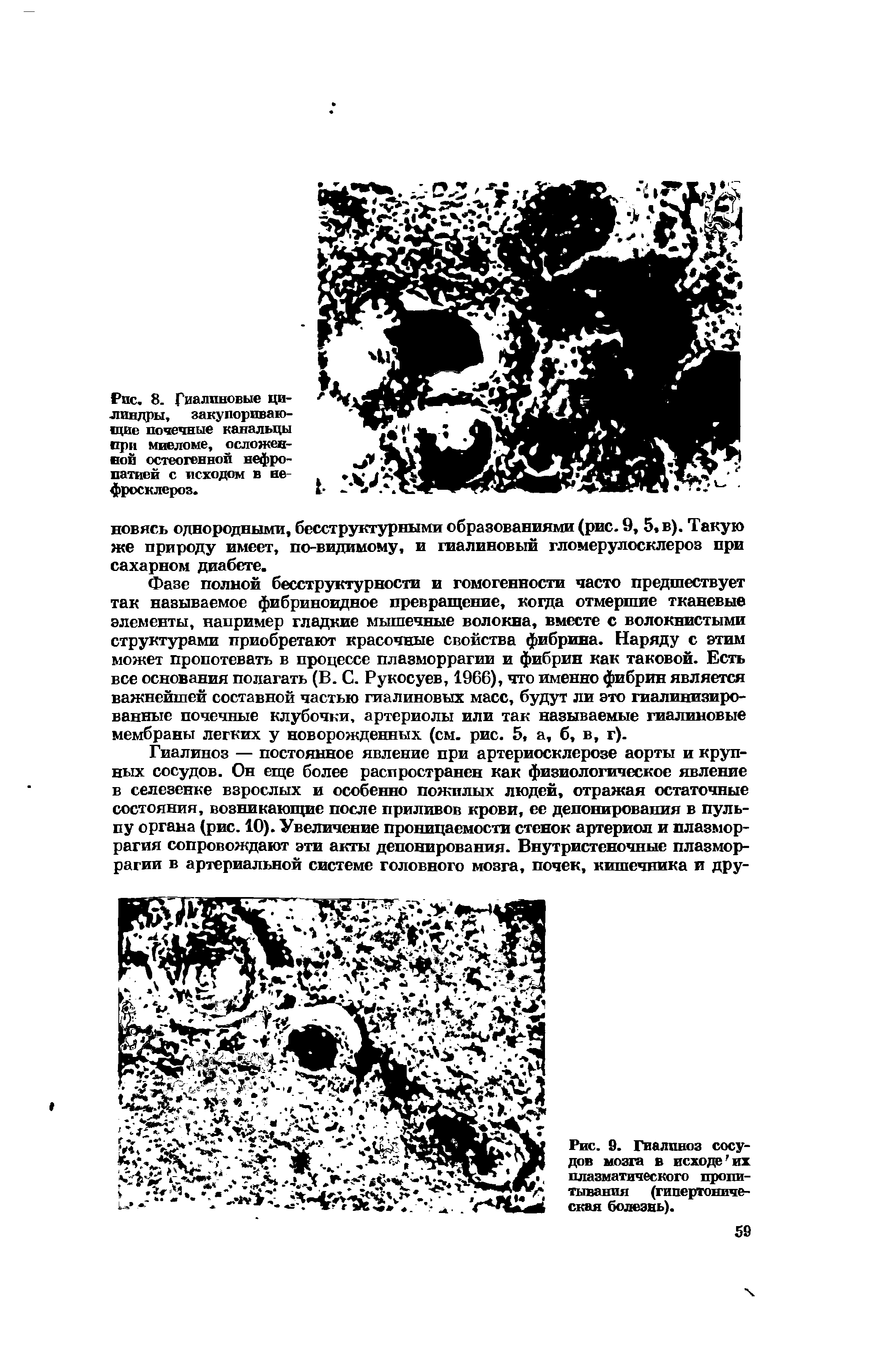 Рис. 9. Гиалиноз сосудов мозга в исходе их плазматического пропитывания (гипертоническая болезнь).