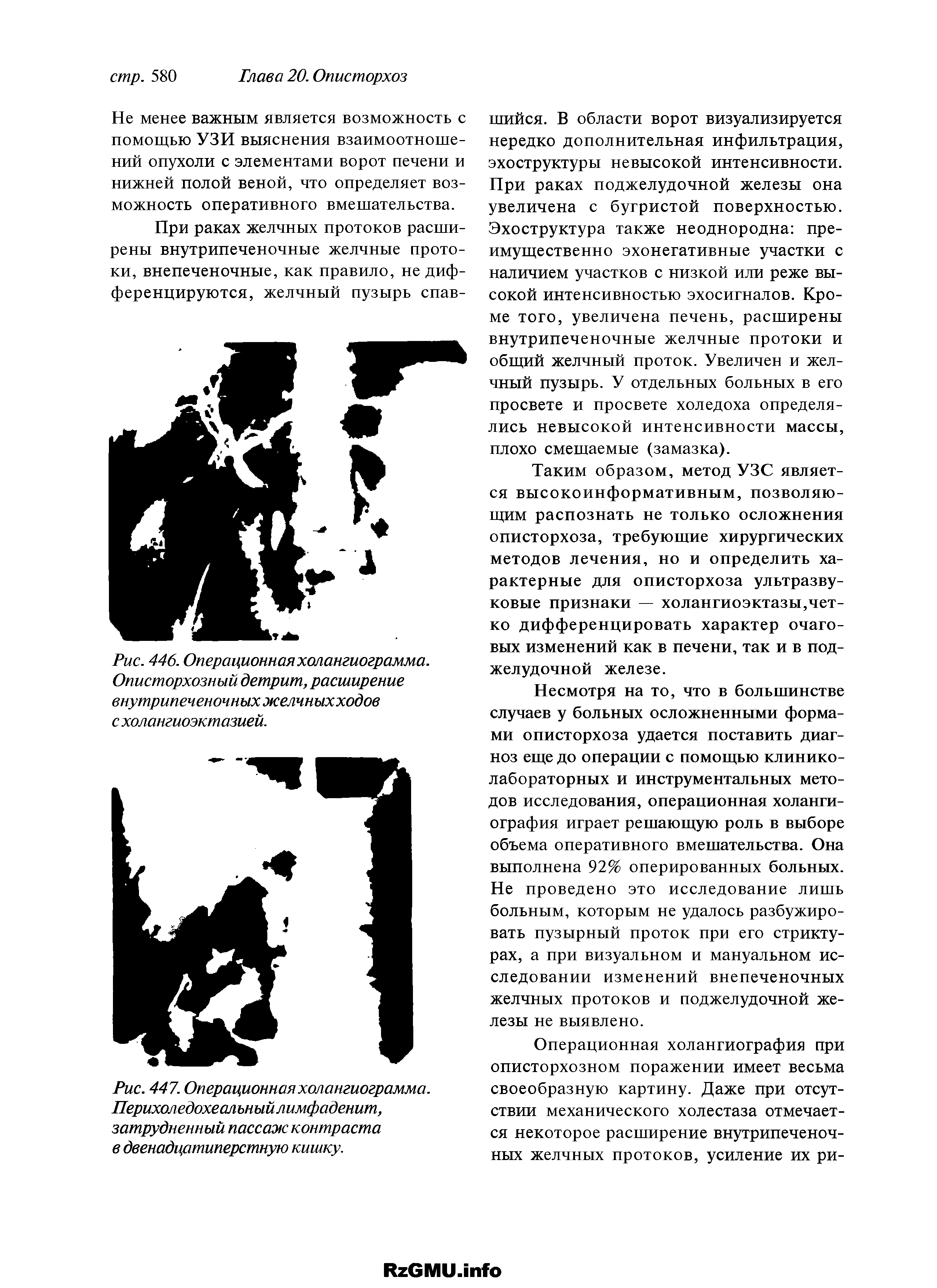 Рис. 446. Операционная холангиограмма. Описторхозный детрит, расширение внутрипеченочных желчныхходов с холангиоэктазией.