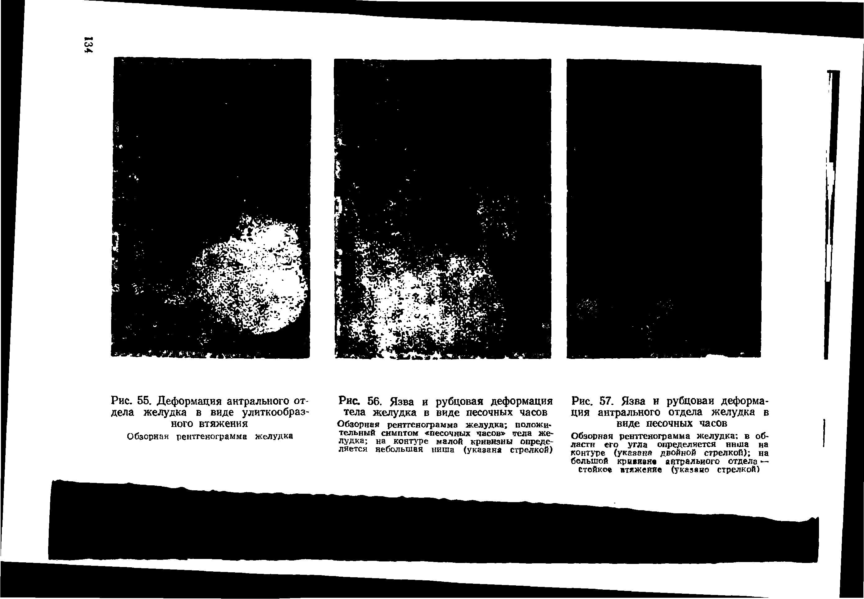 Рис. 56. Язва и рубцовая деформация тела желудка в виде песочных часов Обзорная рентгенограмма желудка положи тельный симптом песочных часов тела желудка на контуре малой кривизны определяется небольшая ниша (указана стрелкой)...