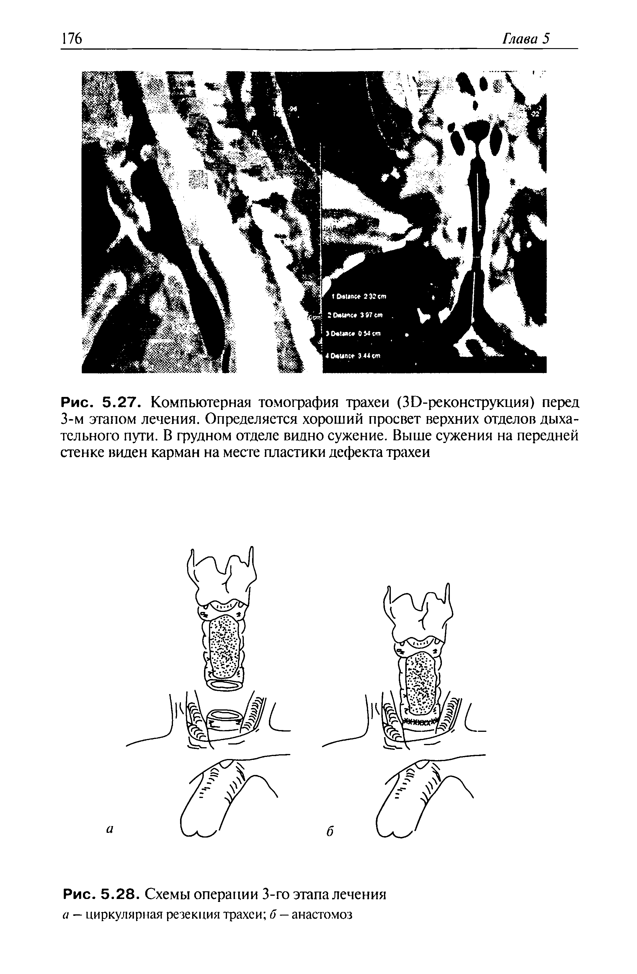Рис. 5.28. Схемы операции 3-го этапа лечения а — циркулярная резекция трахеи б — анастомоз...