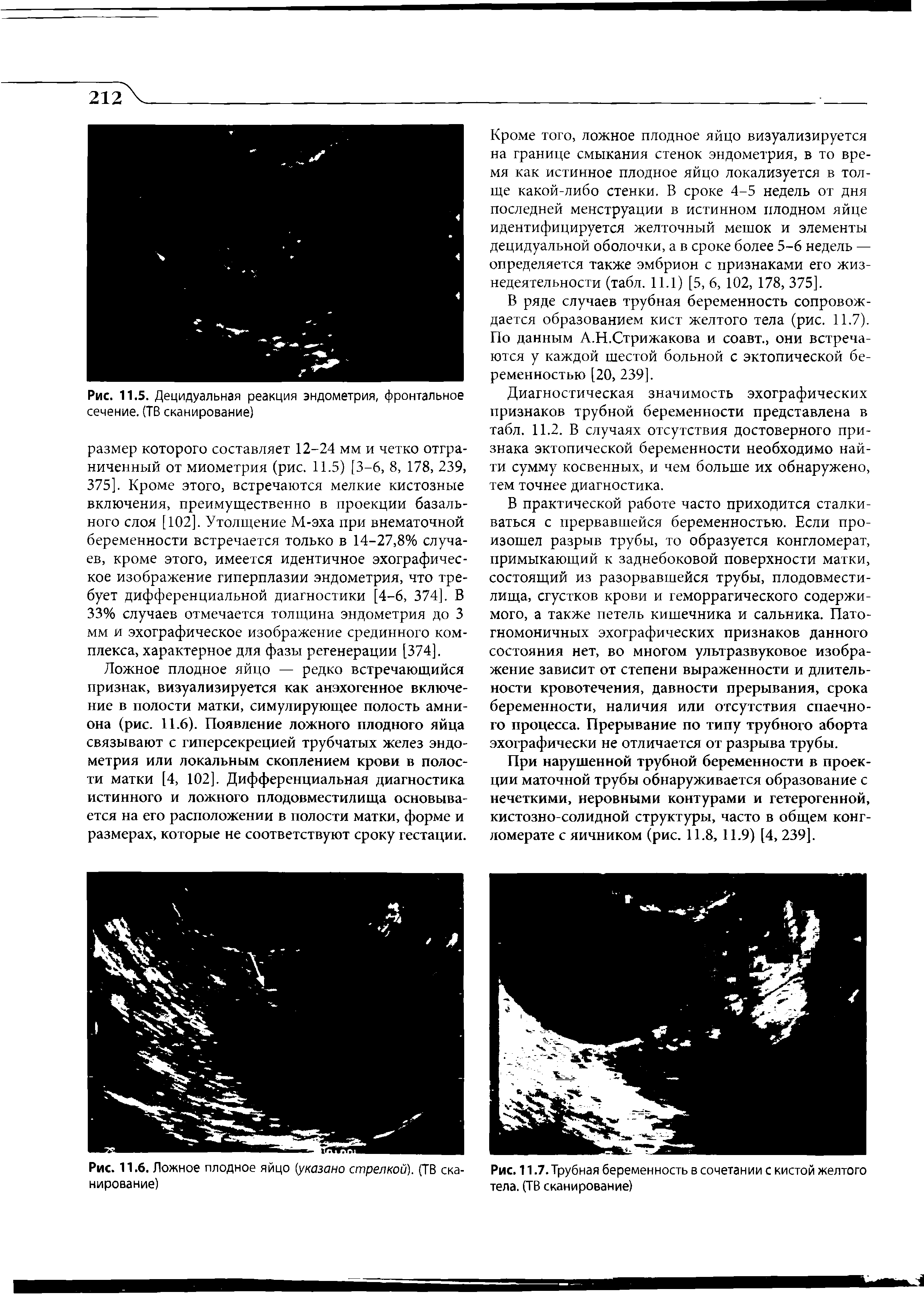 Рис. 11.7. Трубная беременность в сочетании с кистой желтого тела. (ТВ сканирование)...