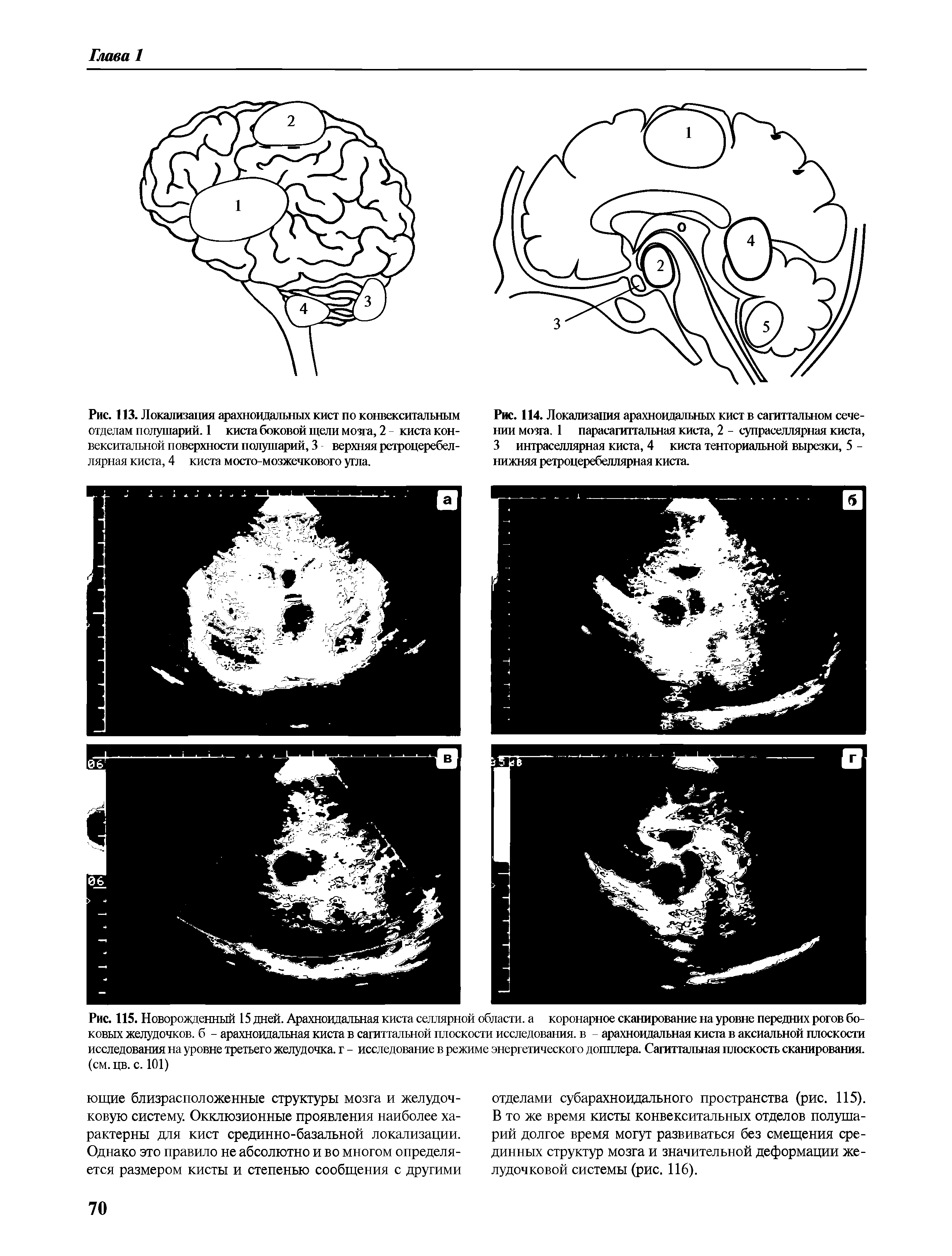Рис. 113. Локализация арахноидальных кист по конвекситальным отделам полушарий. 1 киста боковой щели мозга, 2 - киста конвекситальной поверхности полушарий, 3 верхняя ретроцеребеллярная киста, 4 киста мосто-мозжечкового угла.