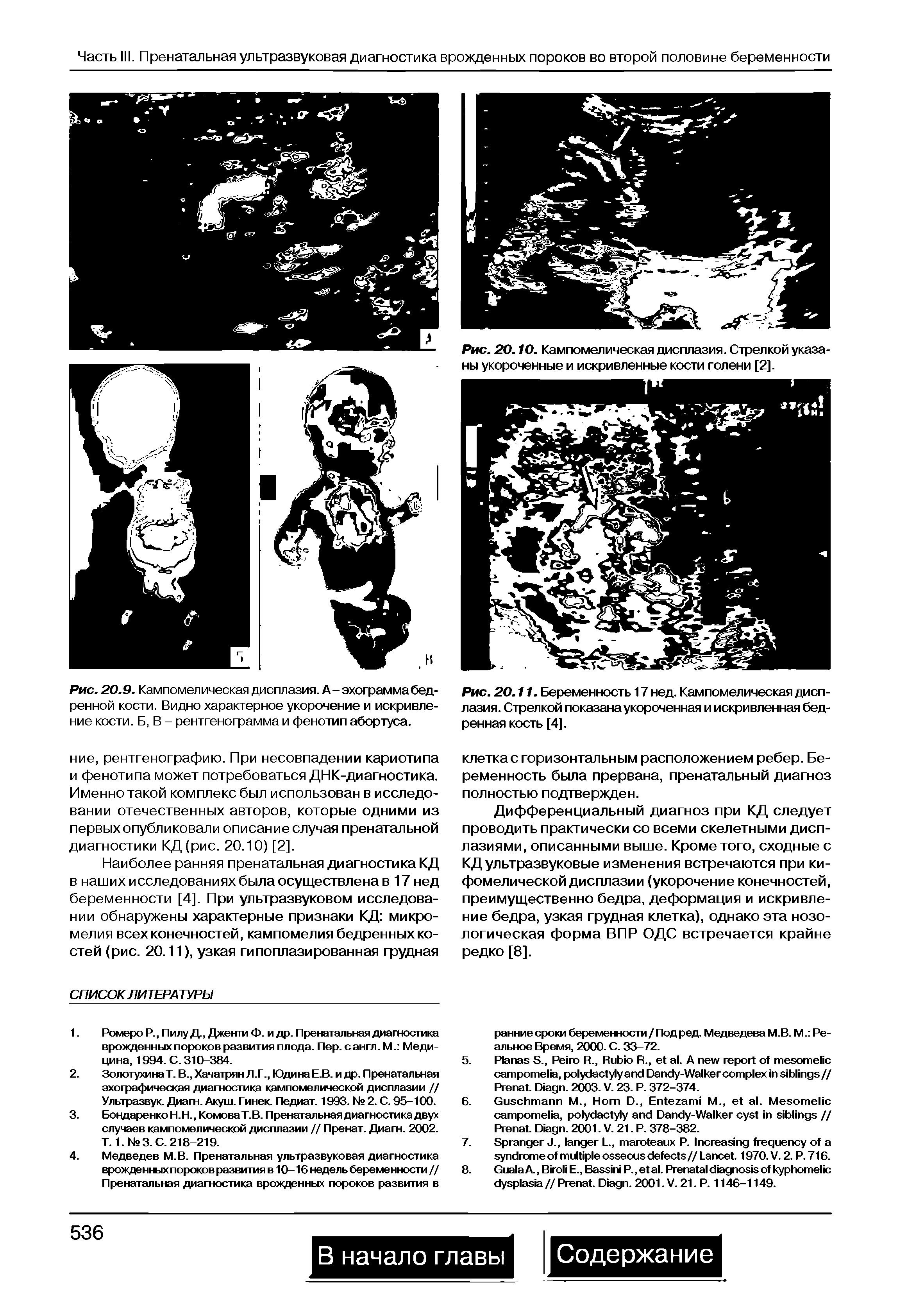 Рис. 20.9. Кампомелическая дисплазия. А- эхограмма бедренной кости. Видно характерное укорочение и искривление кости. Б, В - рентгенограмма и фенотип абортуса.