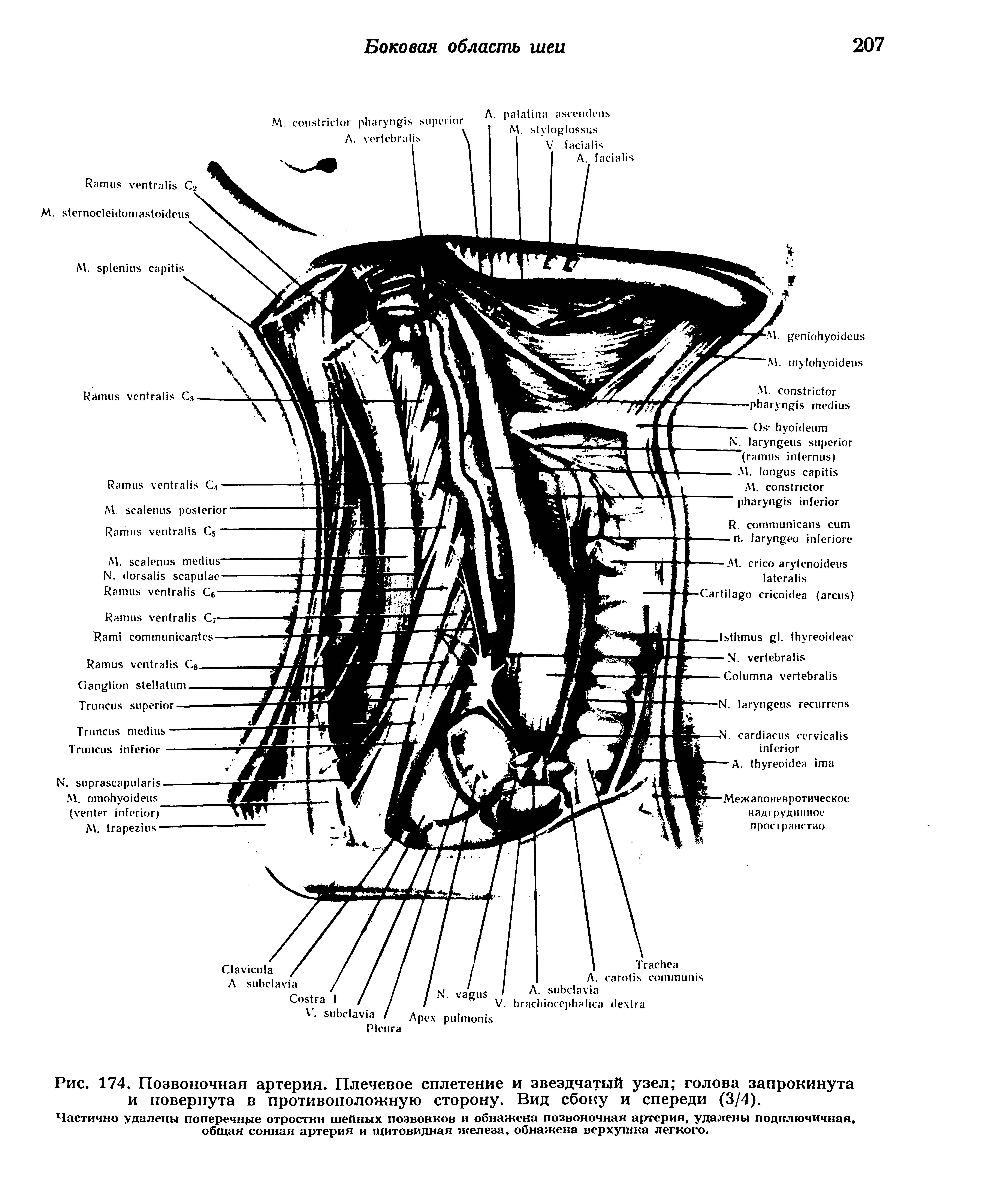 Рис. 174. Позвоночная артерия. Плечевое сплетение и звездчатый узел голова запрокинута и повернута в противоположную сторону. Вид сбоку и спереди (3/4).