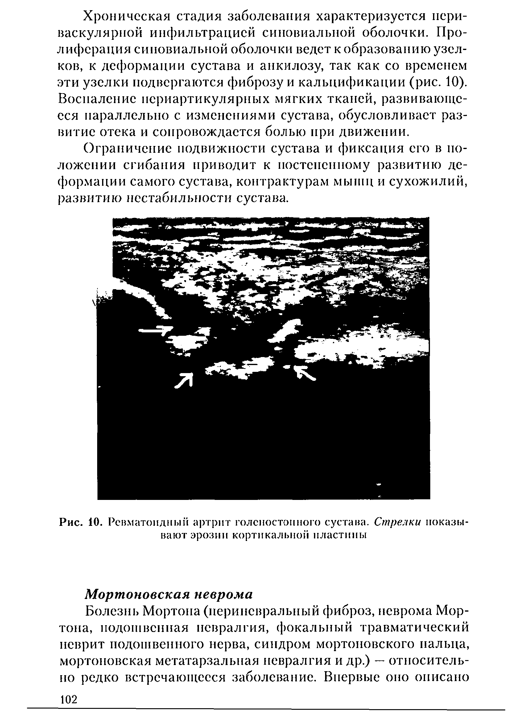 Рис. 10. Ревматоидный артрит голеностопного сустава. Стрелки показывают эрозии кортикальной пластины...