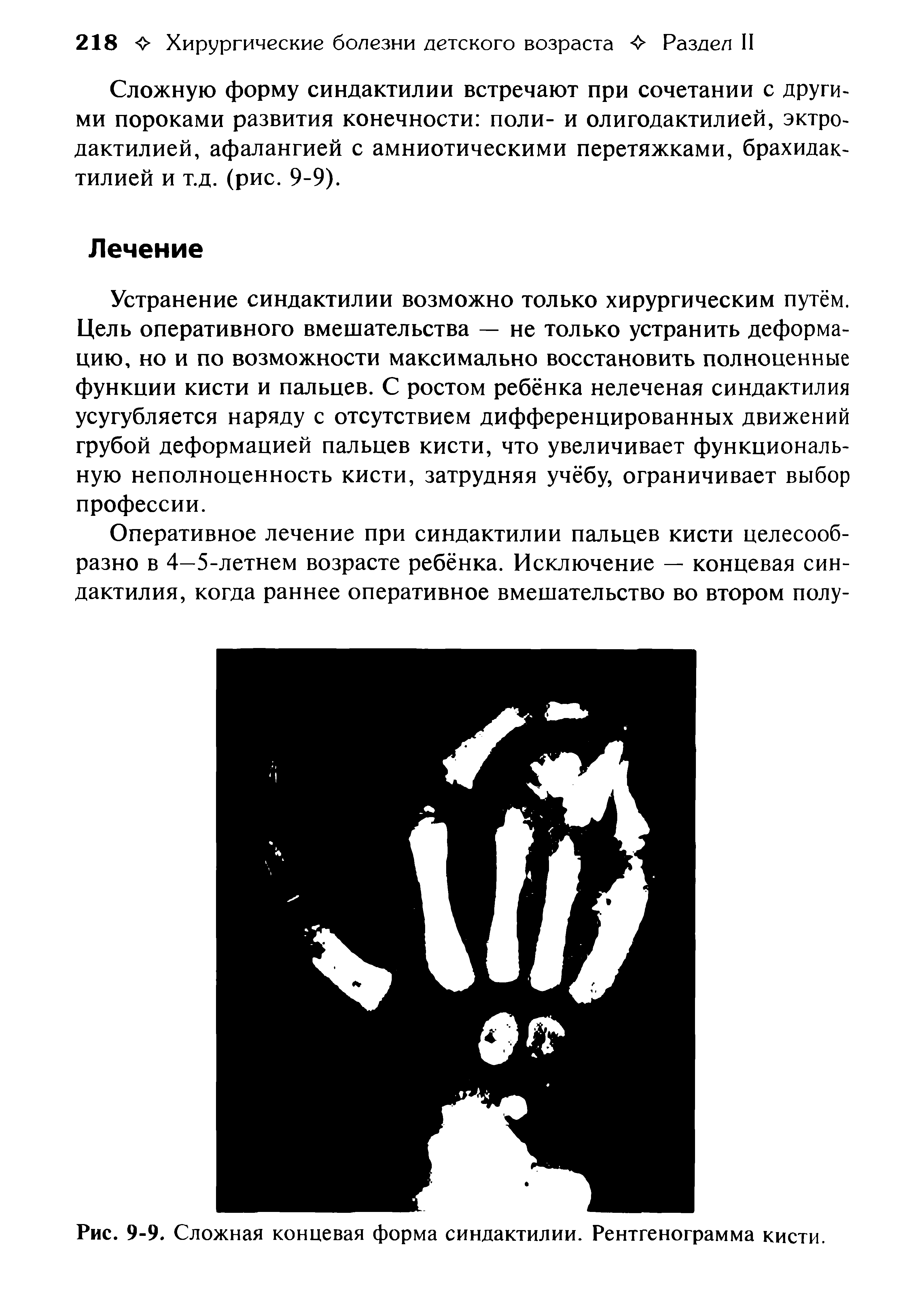 Рис. 9-9. Сложная концевая форма синдактилии. Рентгенограмма кисти.