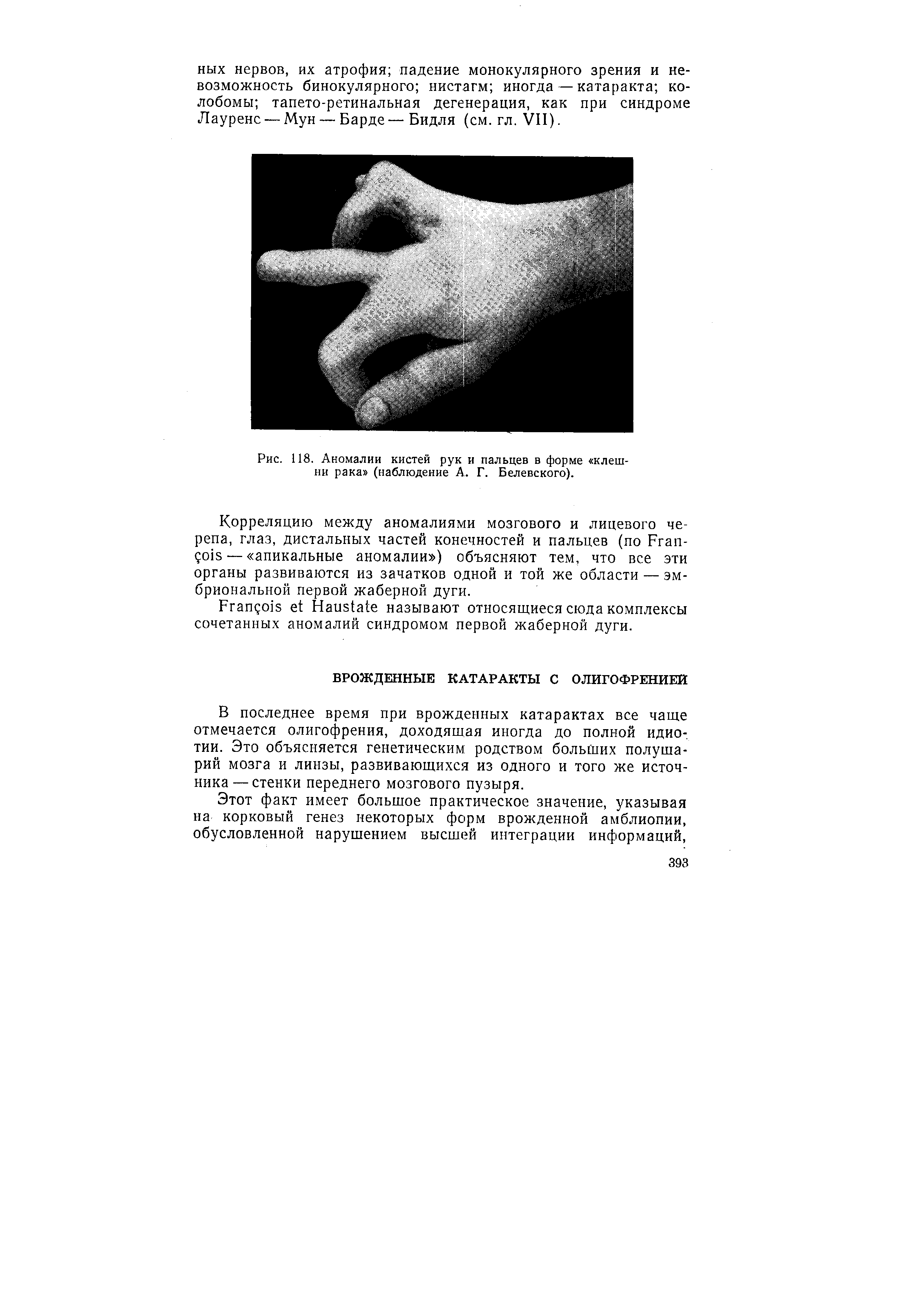 Рис. 118. Аномалии кистей рук и пальцев в форме клешни рака (наблюдение А. Г. Белевского).