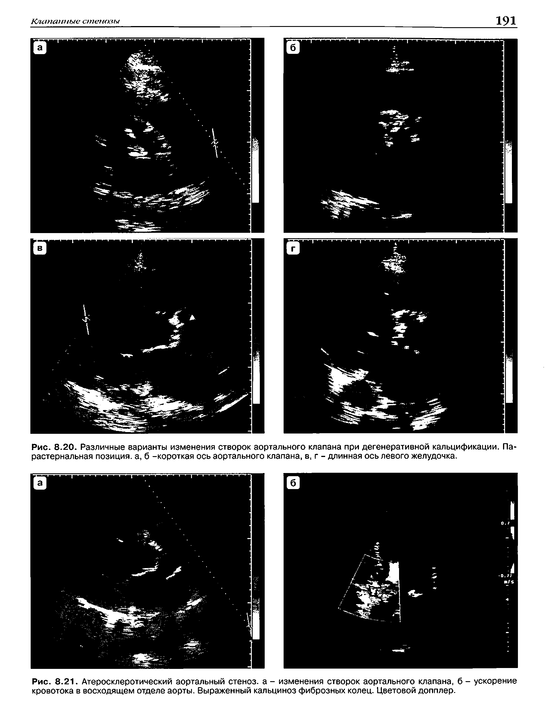 Рис. 8.21. Атеросклеротический аортальный стеноз, а - изменения створок аортального клапана, б - ускорение кровотока в восходящем отделе аорты. Выраженный кальциноз фиброзных колец. Цветовой допплер.