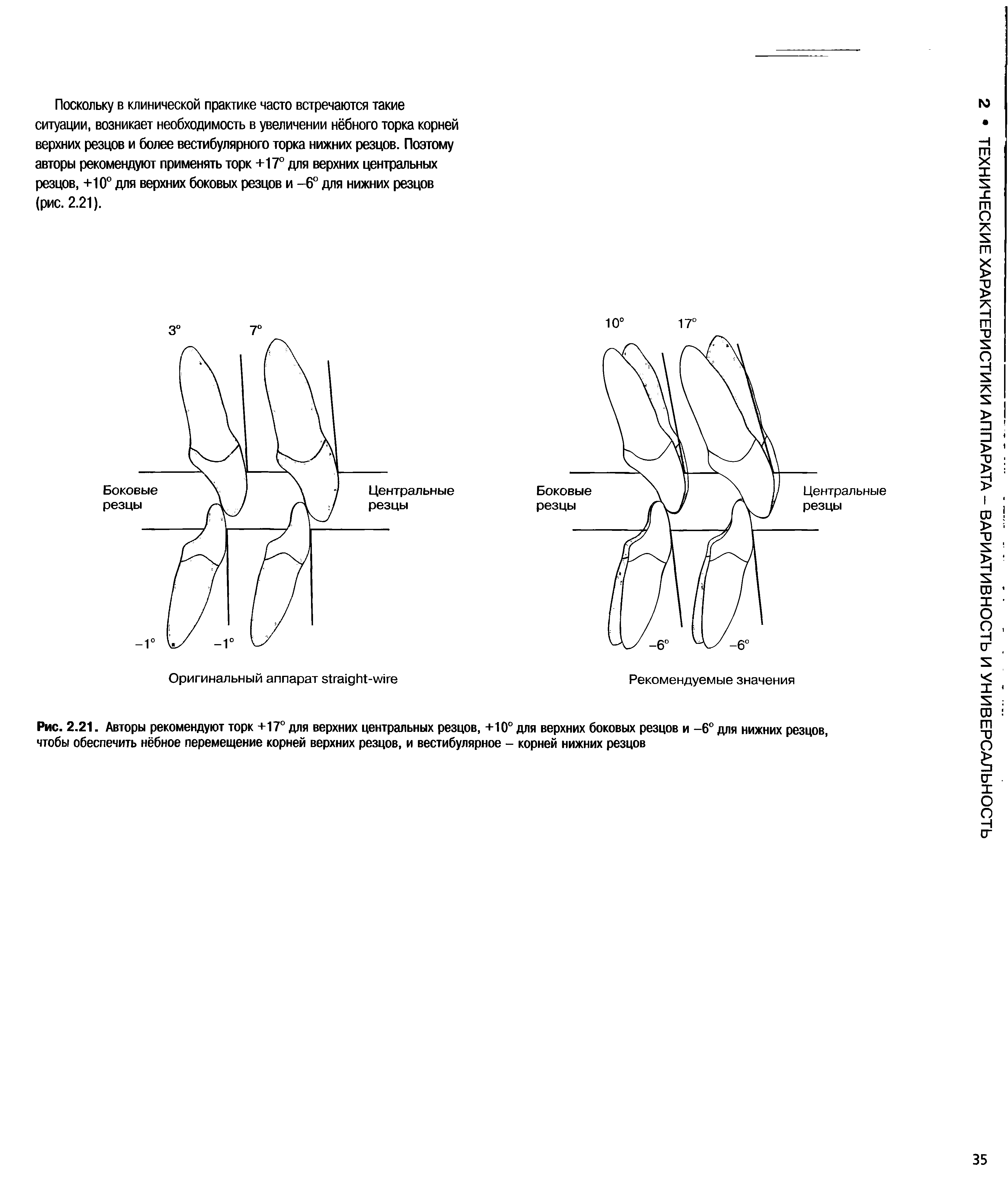 Рис. 2.21. Авторы рекомендуют торк +17° для верхних центральных резцов, +10° для верхних боковых резцов и -6° для нижних резцов, чтобы обеспечить нёбное перемещение корней верхних резцов, и вестибулярное - корней нижних резцов...