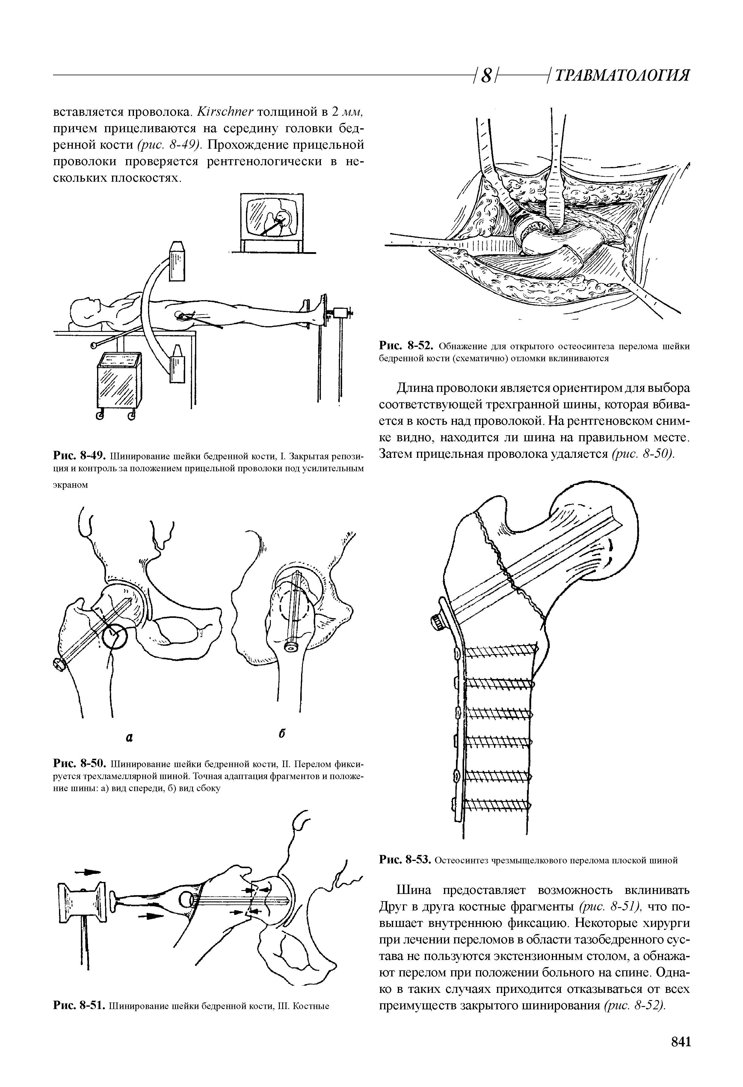 Рис. 8-50. Шинирование шейки бедренной кости, II. Перелом фиксируется трехламеллярной шиной. Точная адаптация фрагментов и положение шины а) вид спереди, б) вид сбоку...