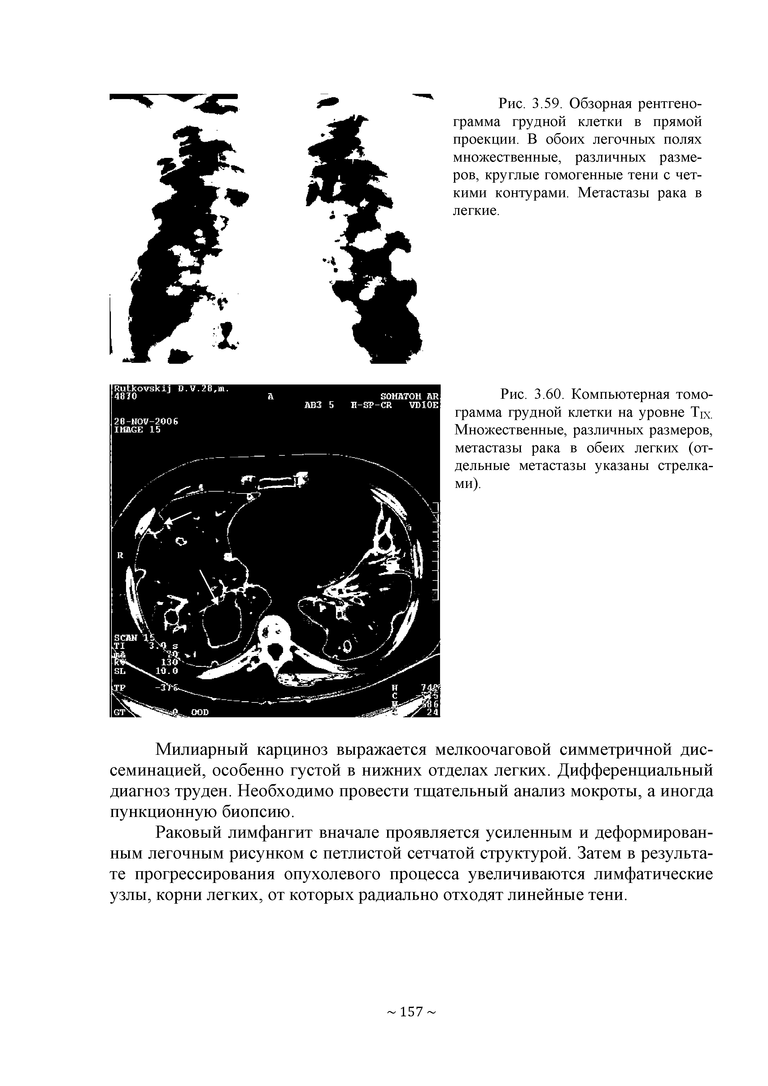 Рис. 3.60. Компьютерная томограмма грудной клетки на уровне Тк. Множественные, различных размеров, метастазы рака в обеих легких (отдельные метастазы указаны стрелками).