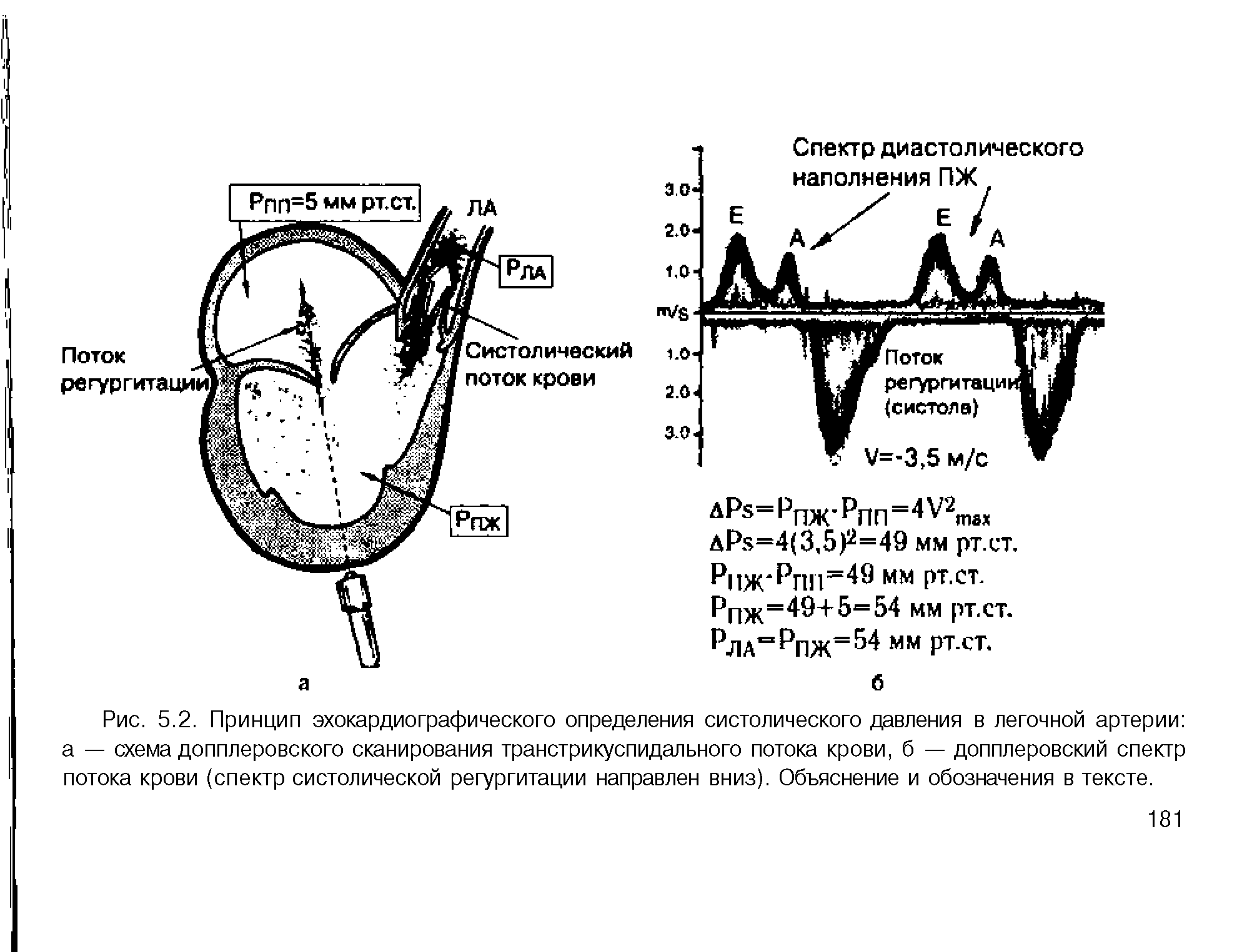 Рис. 5.2. Принцип эхокардиографического определения систолического давления в легочной артерии а — схема допплеровского сканирования транстрикуспидального потока крови, б — допплеровский спектр потока крови (спектр систолической регургитации направлен вниз). Объяснение и обозначения в тексте.