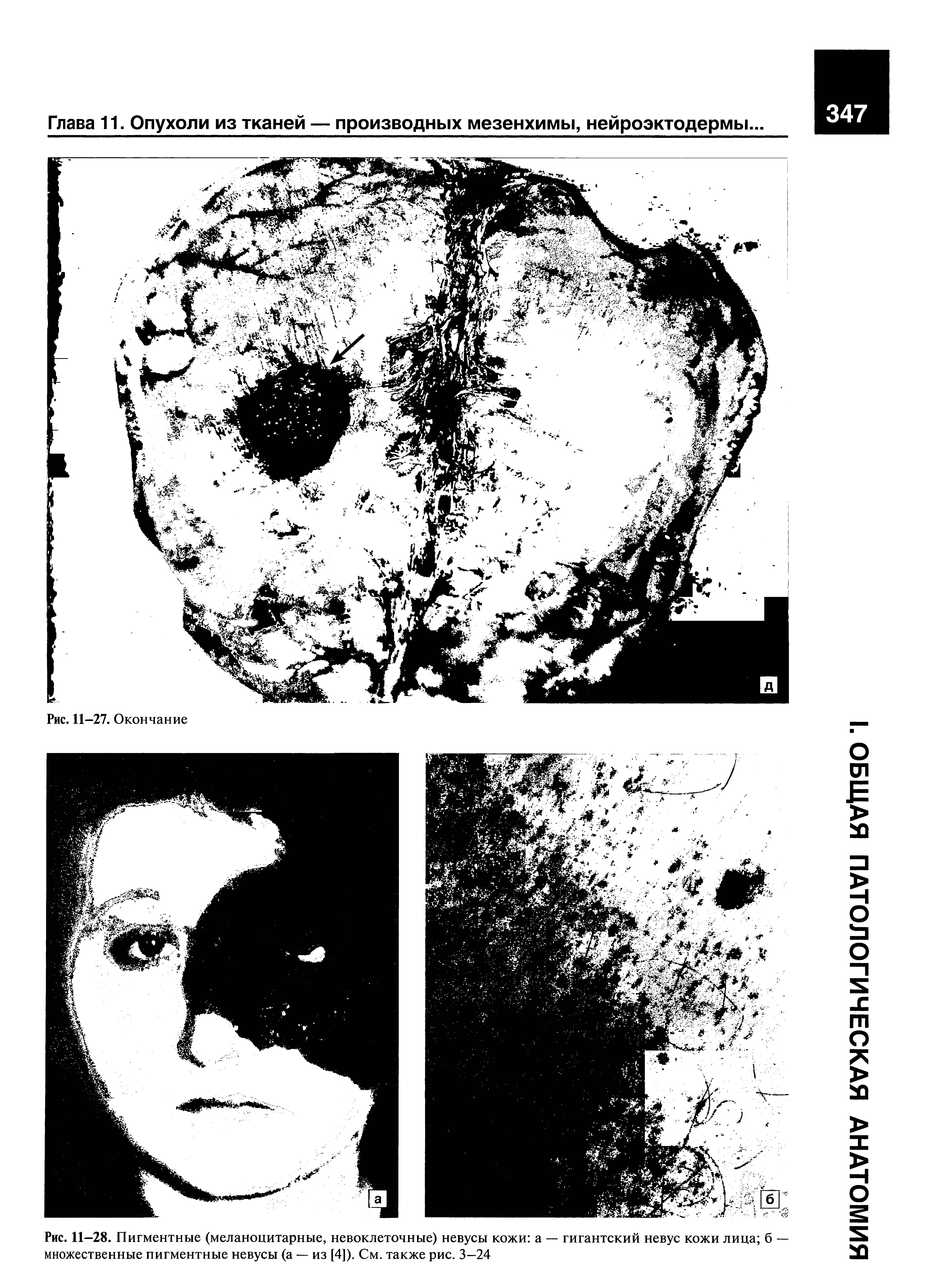 Рис. 11—28. Пигментные (меланоцитарные, невоклеточные) невусы кожи а — гигантский невус кожи лица б — множественные пигментные невусы (а — из [4]). См. также рис. 3—24...