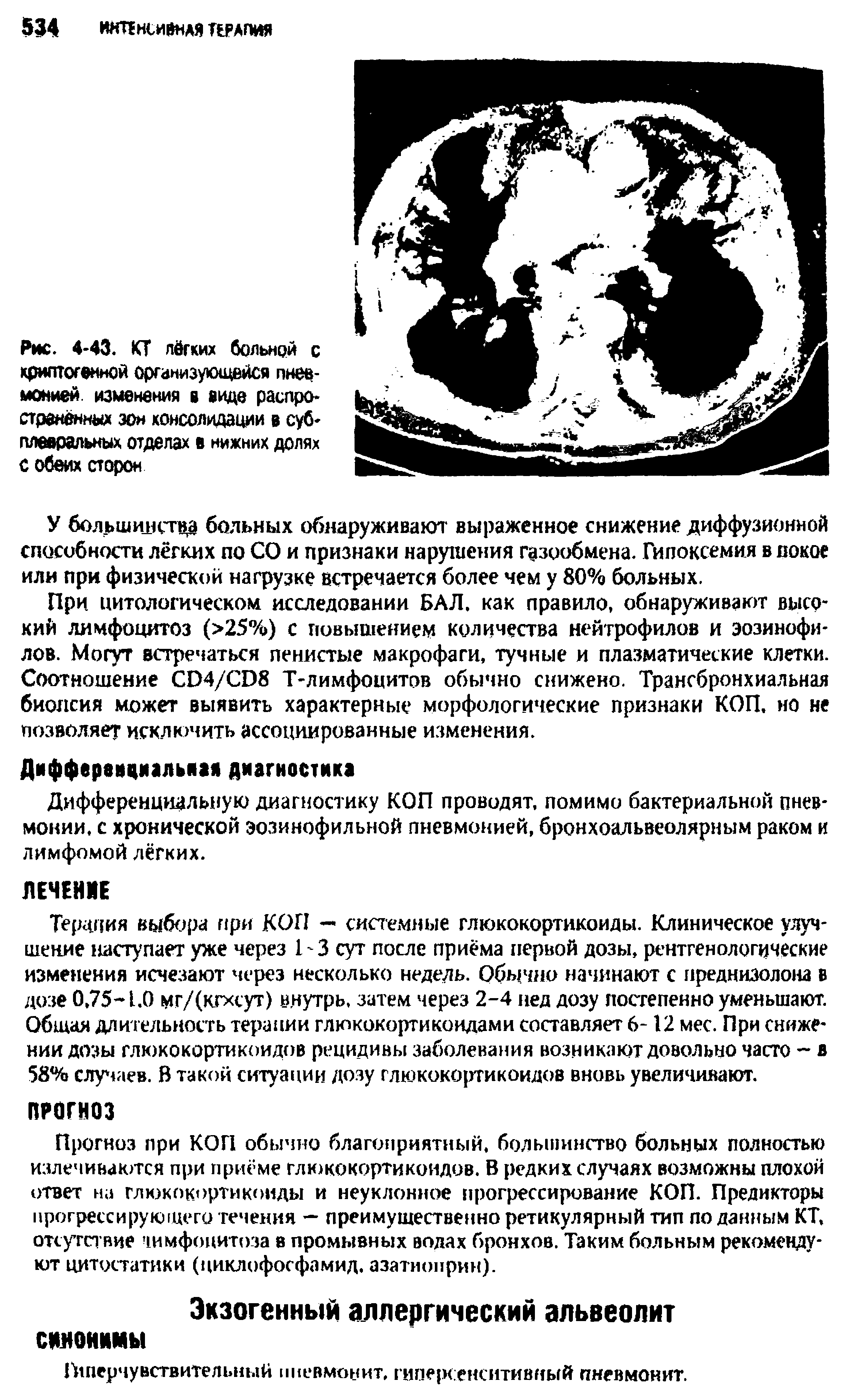 Рис. 4-43. КТ лёгких больней с криптогенной организующейся пневмонией. изменения в виде распространённых зон консолидации в суб-плевральных отделах в нижних долях с обеих сторон...