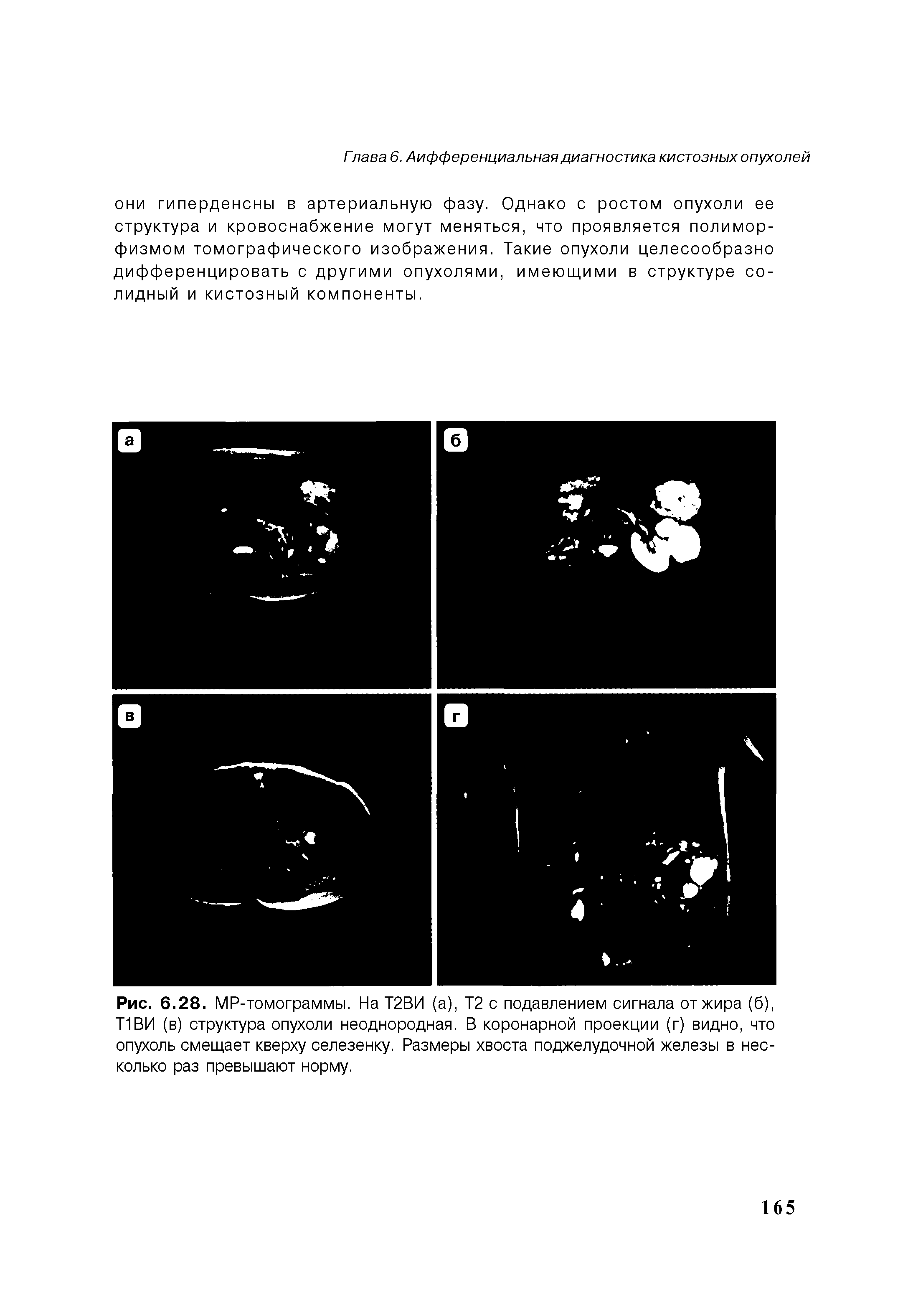 Рис. 6.28. МР-томограммы. На Т2ВИ (а), Т2 с подавлением сигнала от жира (б), Т1ВИ (в) структура опухоли неоднородная. В коронарной проекции (г) видно, что опухоль смещает кверху селезенку. Размеры хвоста поджелудочной железы в несколько раз превышают норму.