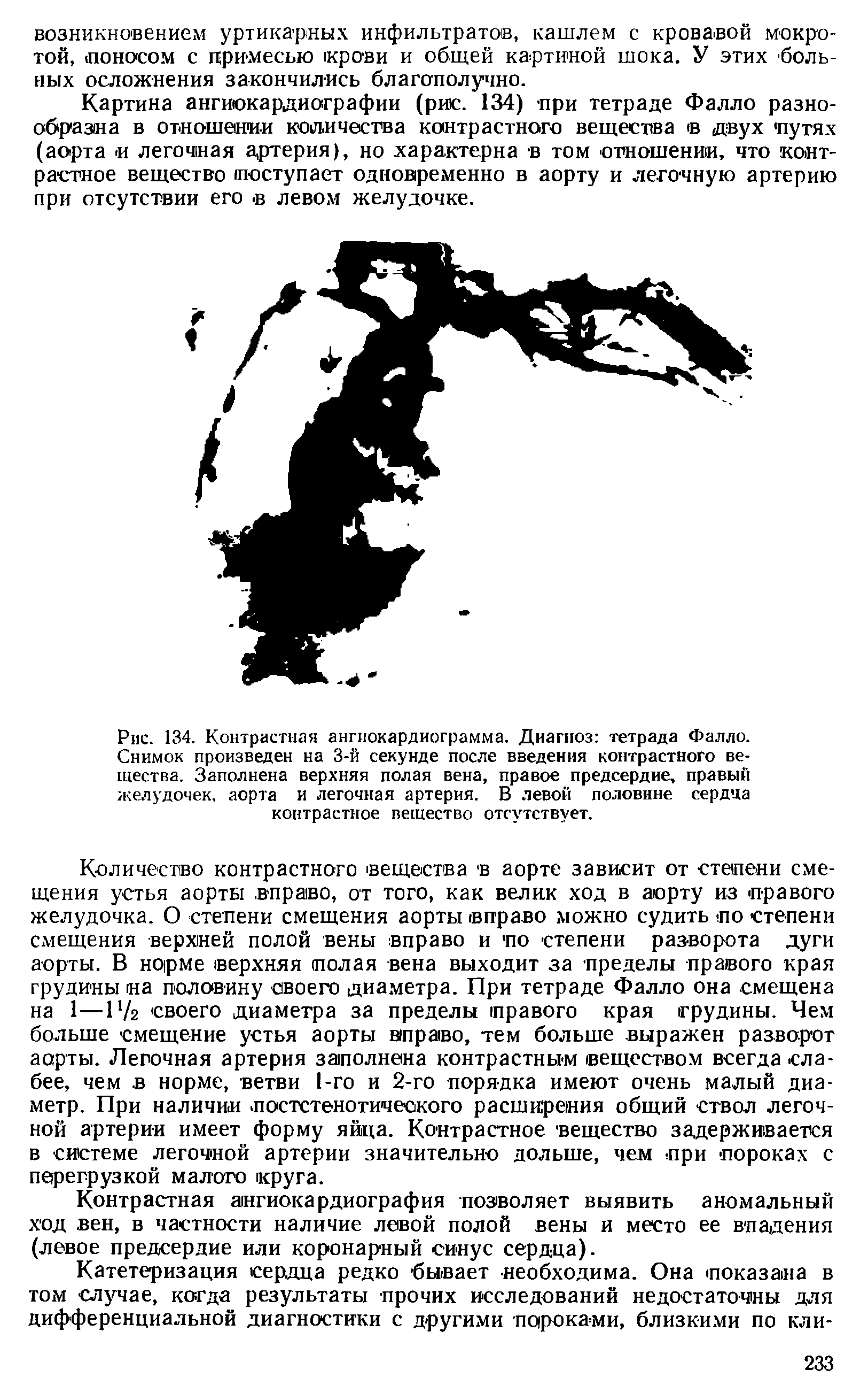 Рис. 134. Контрастная ангиокардиограмма. Диагноз тетрада Фалло. Снимок произведен на 3-й секунде после введения контрастного вещества. Заполнена верхняя полая вена, правое предсердие, правый желудочек, аорта и легочная артерия. В левой половине сердца контрастное вещество отсутствует.