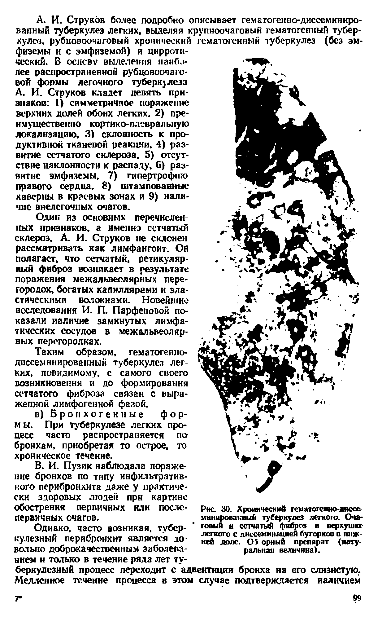 Рис. 30. Хронический гематогепно-днссе-мннировакиыА туберкулез легкого. Оча- говый и сетчатый фиброз в верхушке легкого с днесемииацией бугорков в лишней доле. 05 орный препарат (натуральная величина).