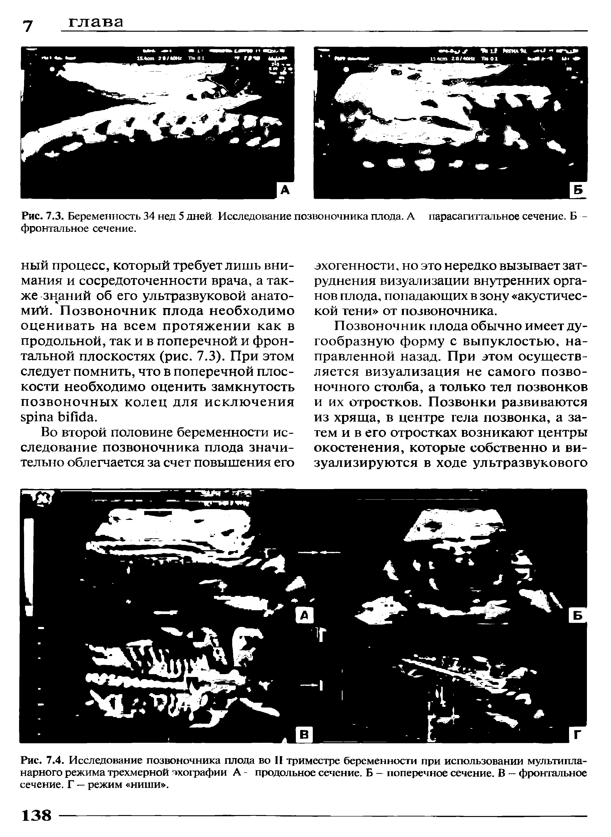 Рис. 7.4. Исследование позвоночника плода во II триместре беременности при использовании мультипла-нарного режима трехмерной эхографии А - продольное сечение. Б - поперечное сечение. В - фронтальное сечение. Г — режим ниши .