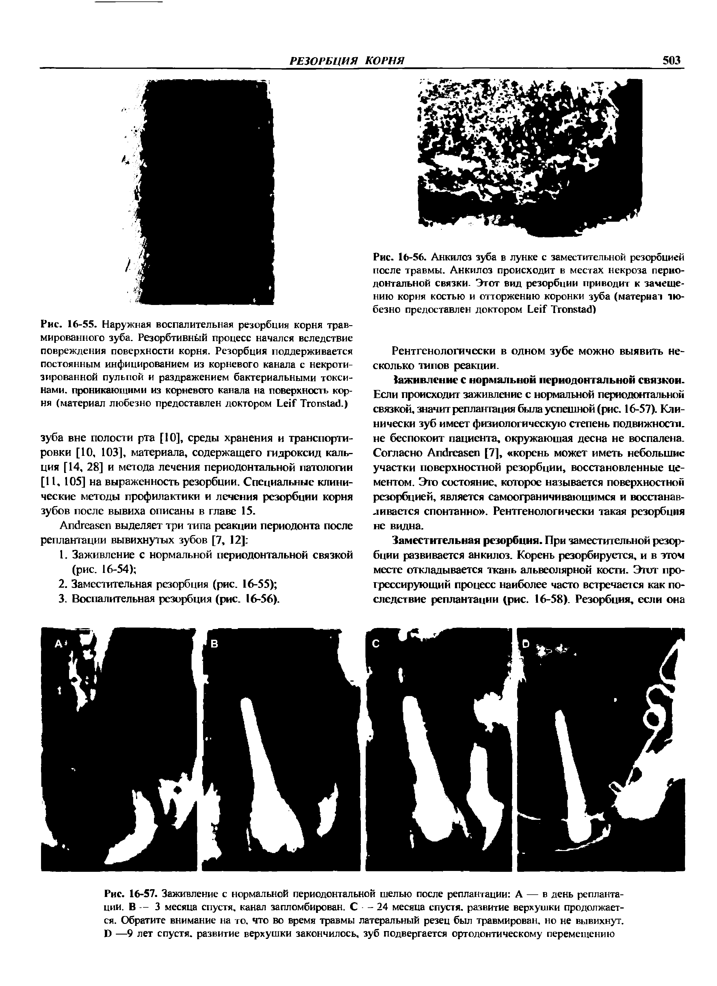 Рис. 16-57. Заживление с нормальной периодонтальной щелью после реплантации А — в день реплантации. В — 3 месяца спустя, канал запломбирован. С - 24 месяца спустя, развитие верхушки продолжается. Обратите внимание на то, что во время травмы латеральный резец был травмирован, но не вывихнут. Б —9 лет спустя, развитие верхушки закончилось, зуб подвергается ортодонтическому перемещению...