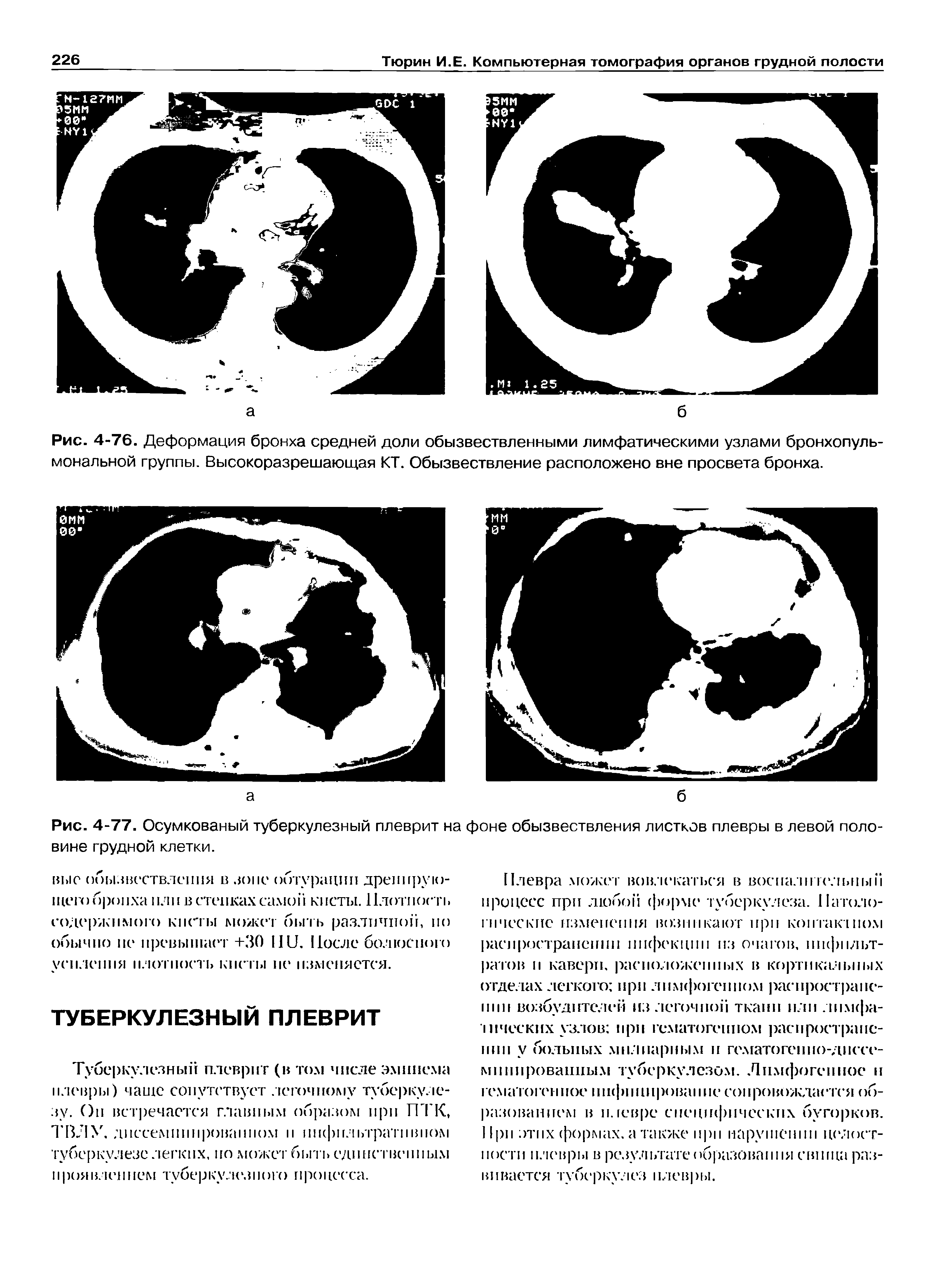 Рис. 4-77. Осумкованый туберкулезный плеврит на фоне обызвествления листков плевры в левой половине грудной клетки.