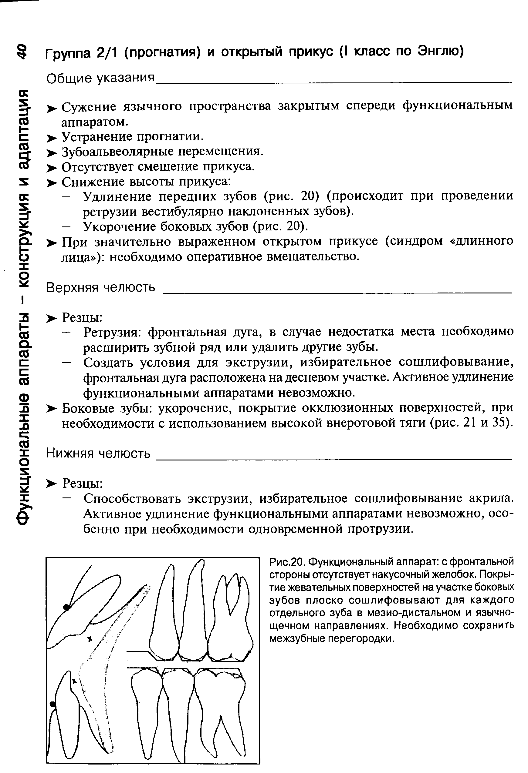 Рис.20. Функциональный аппарат с фронтальной стороны отсутствует накусочный желобок. Покрытие жевательных поверхностей на участке боковых зубов плоско сошлифовывают для каждого отдельного зуба в мезио-дистальном и язычнощечном направлениях. Необходимо сохранить межзубные перегородки.