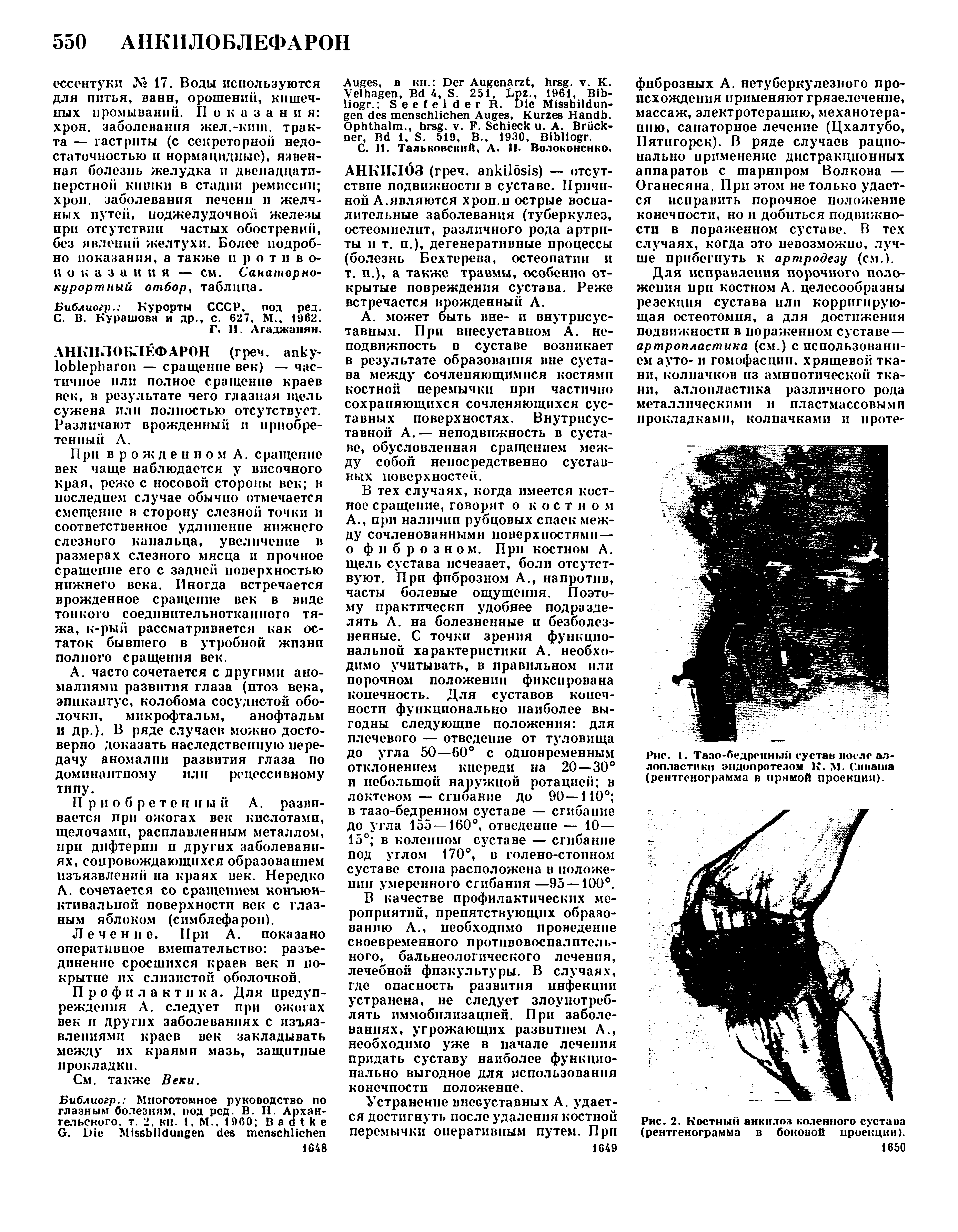 Рис. 1. Тазо-бедренным сустав после аллопластики эндопротезом К. N. Сиваша (рентгенограмма в прямой проекции).