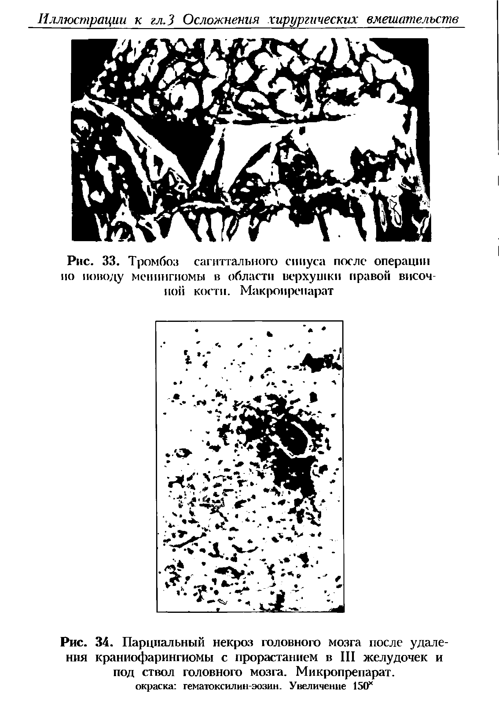 Рис. 34. Парциальный некроз головного мозга после удаления краниофарингиомы с прорастанием в III желудочек и под ствол головного мозга. Микропрепарат.