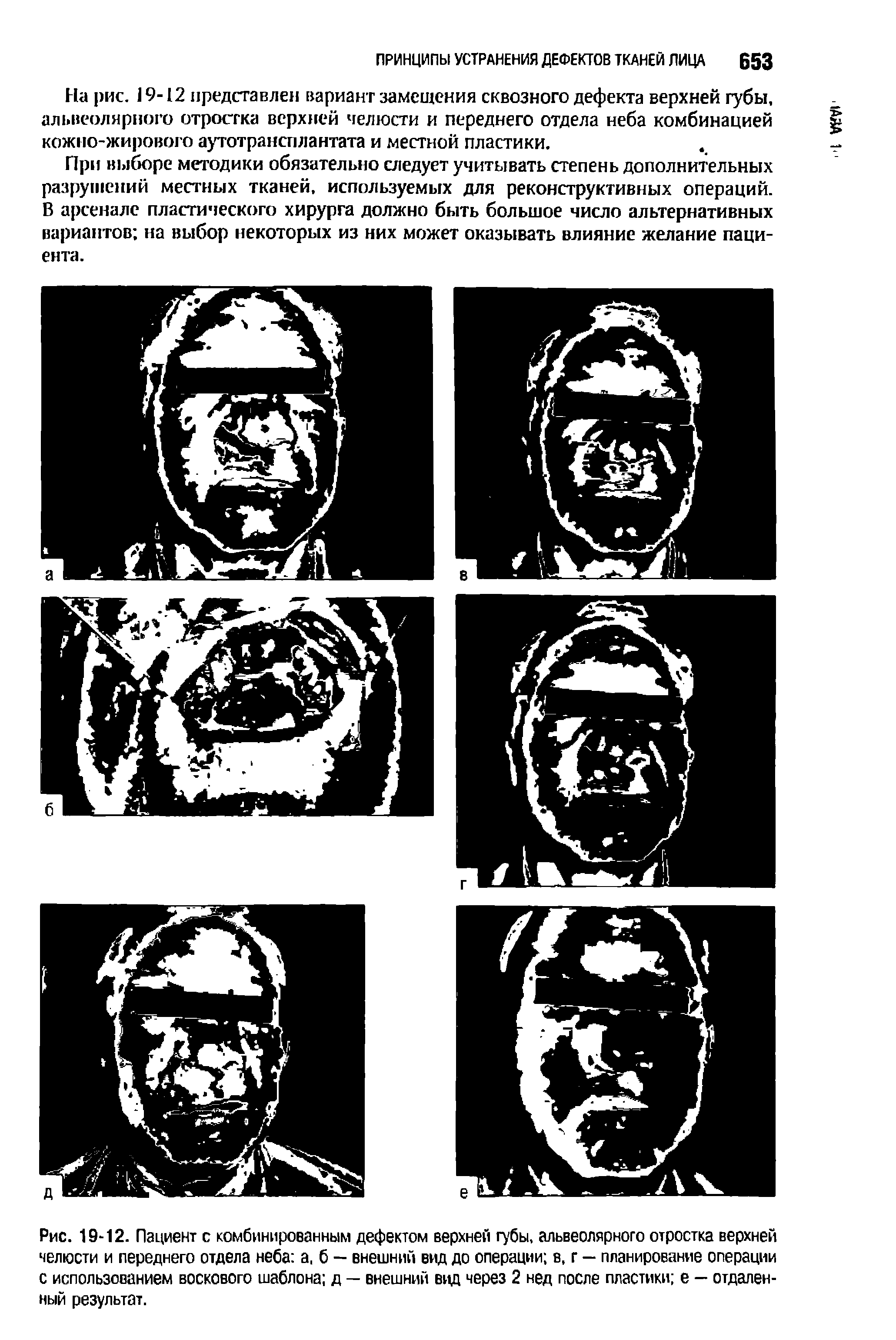 Рис. 19-12. Пациент с комбинированным дефектом верхней губы, альвеолярного отростка верхней челюсти и переднего отдела неба а, б — внешний вид до операции в, г — планирование операции с использованием воскового шаблона д — внешний вид через 2 нед после пластики е — отдаленный результат.