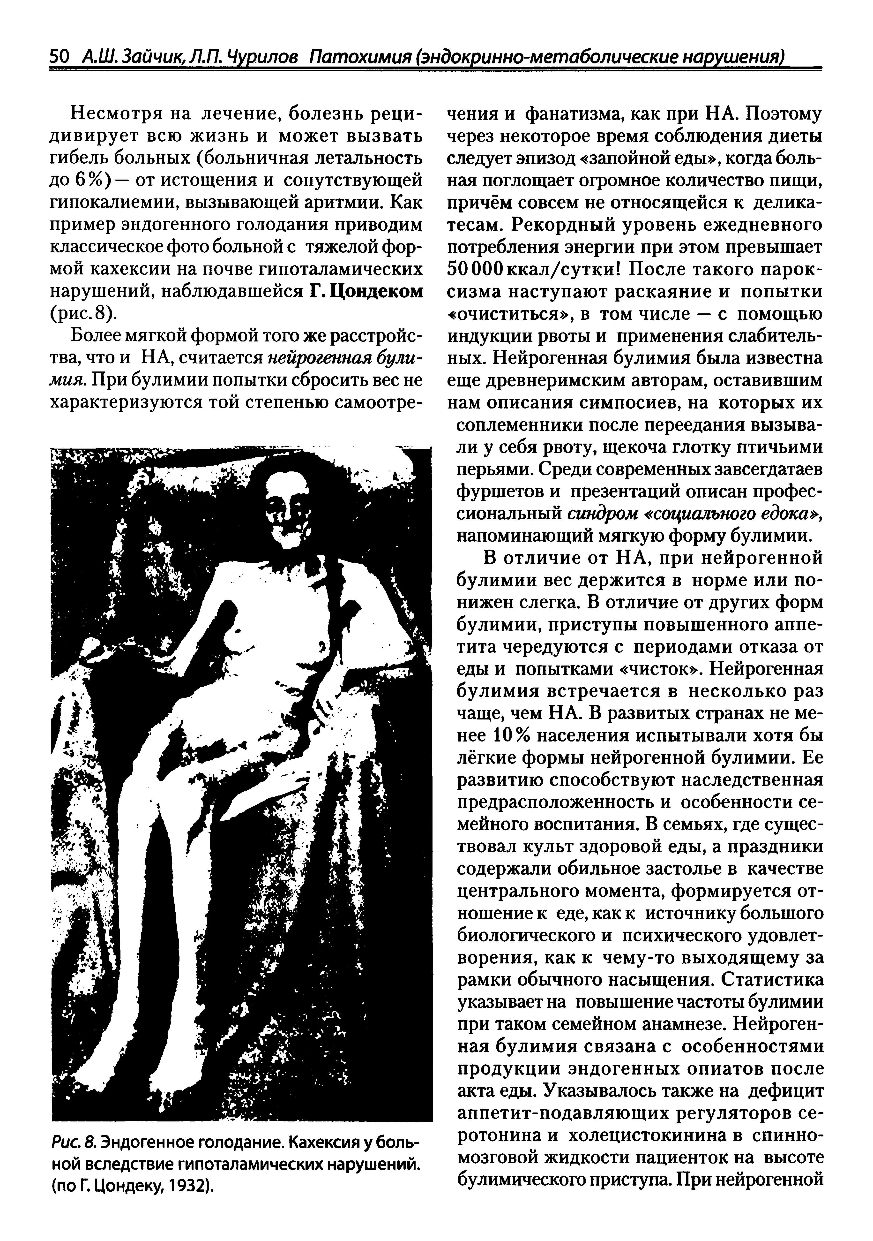 Рис. 8. Эндогенное голодание. Кахексия у больной вследствие гипоталамических нарушений, (по Г. Цондеку, 1932).