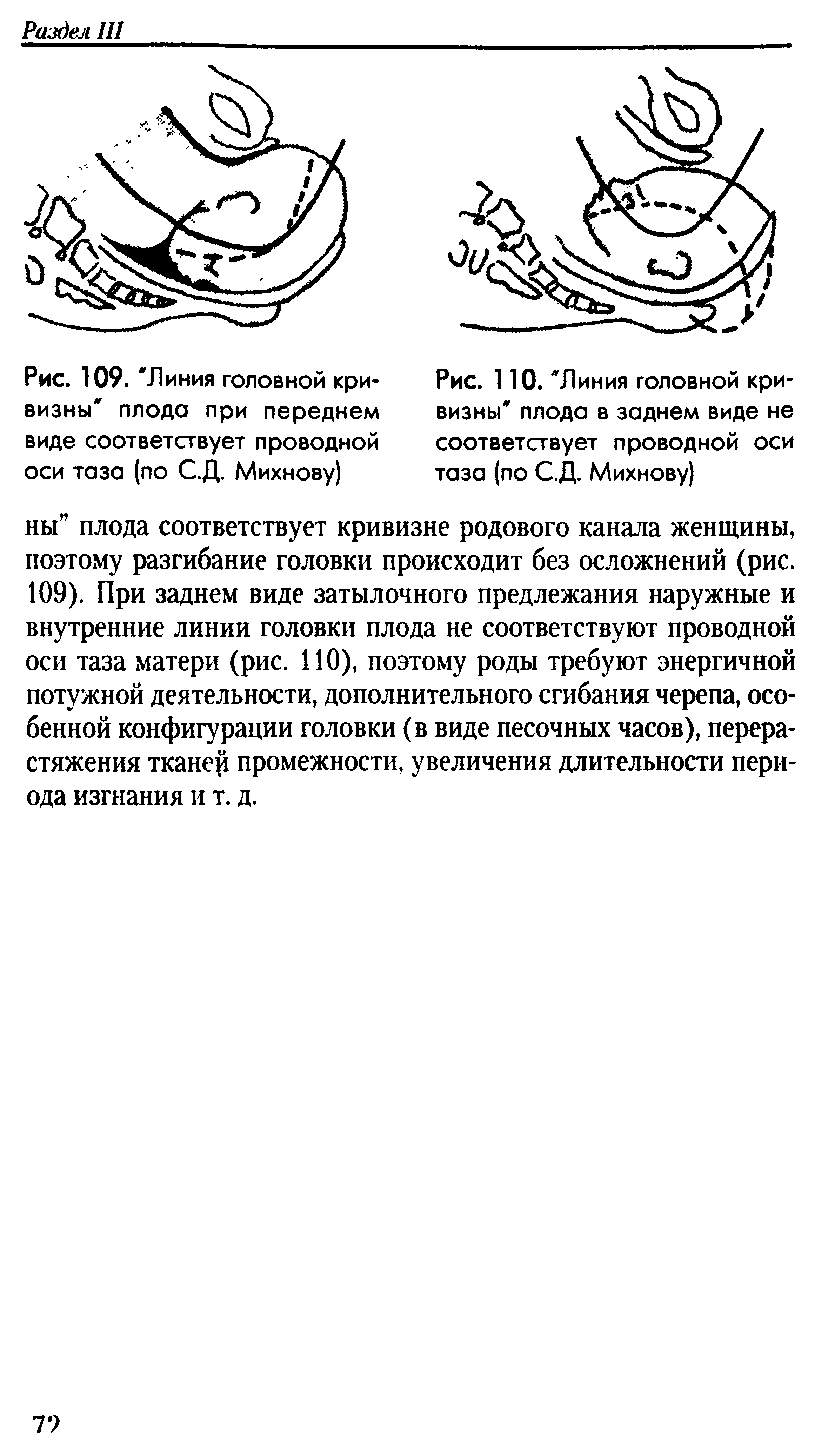 Рис. 109. Линия головной кривизны плода при переднем виде соответствует проводной оси таза (по С.Д. Михнову)...