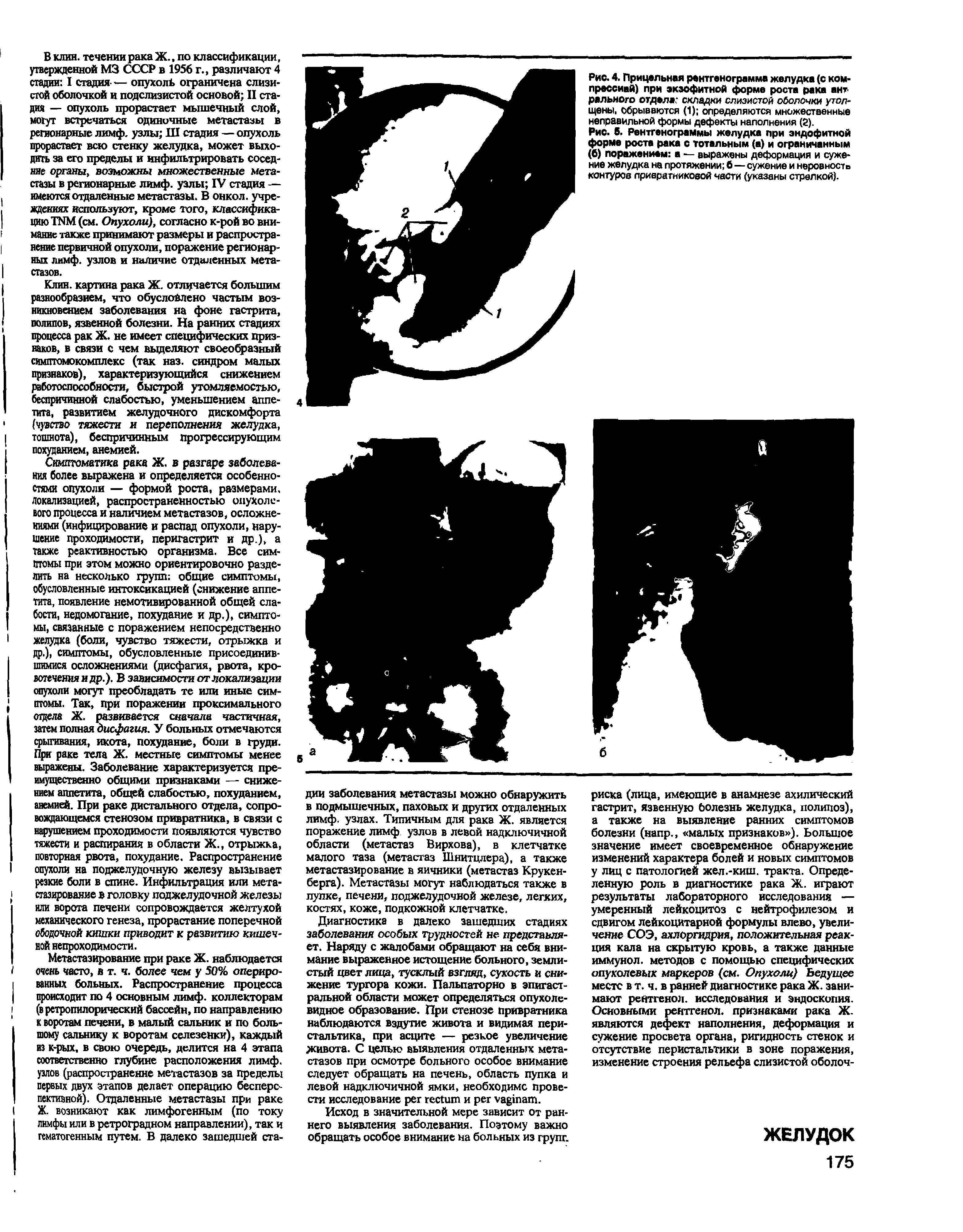 Рис. 5. Рентгенограммы желудка при эндофитной форме роста рака с тотальным (а) и ограниченным (б) поражением а — выражены деформация и сужение желудка на протяжении б — сужение и неровности контуров привратниковой части (указаны стрелкой).