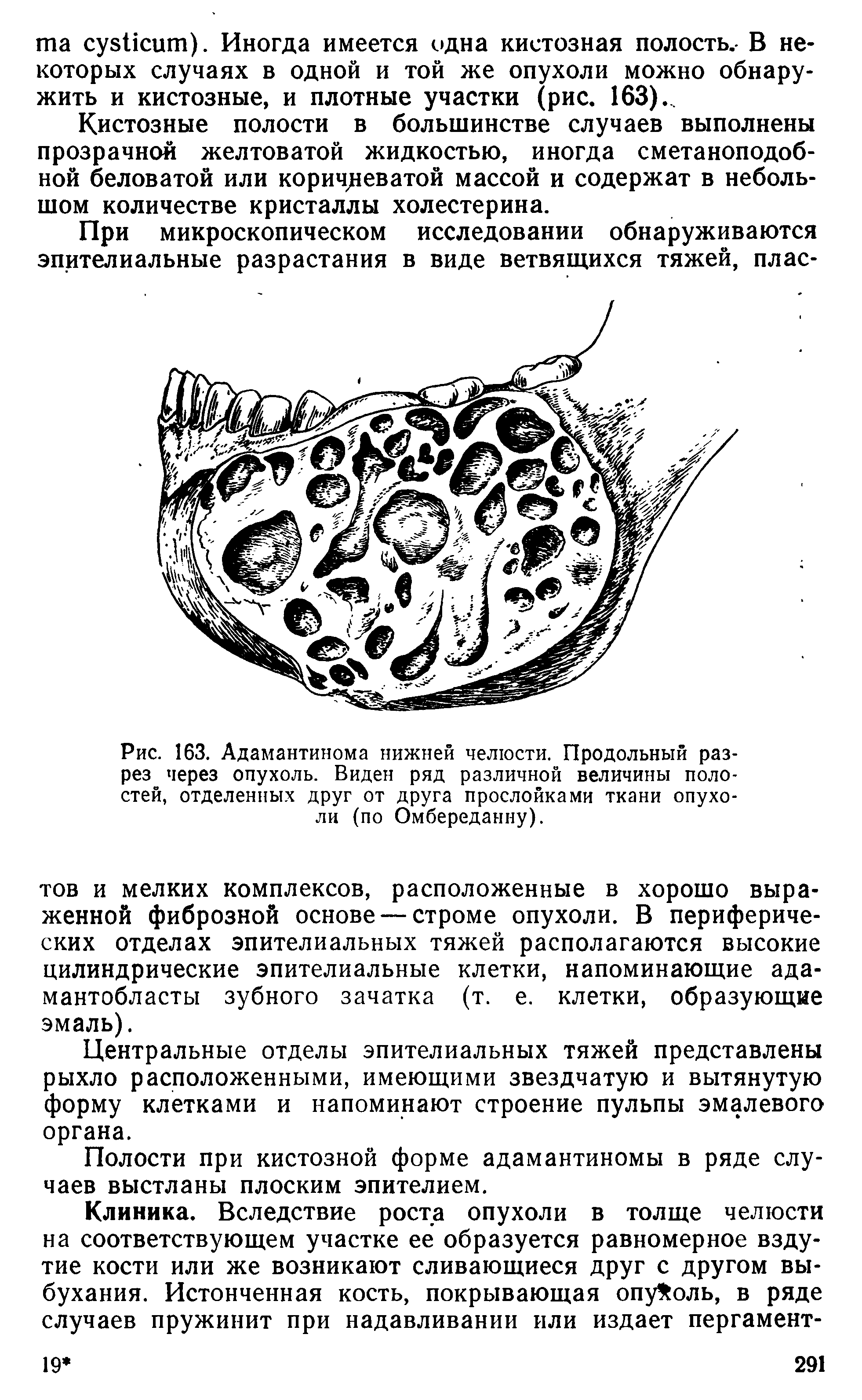 Рис. 163. Адамантинома нижней челюсти. Продольный разрез через опухоль. Виден ряд различной величины полостей, отделенных друг от друга прослойками ткани опухоли (по Омбереданну).