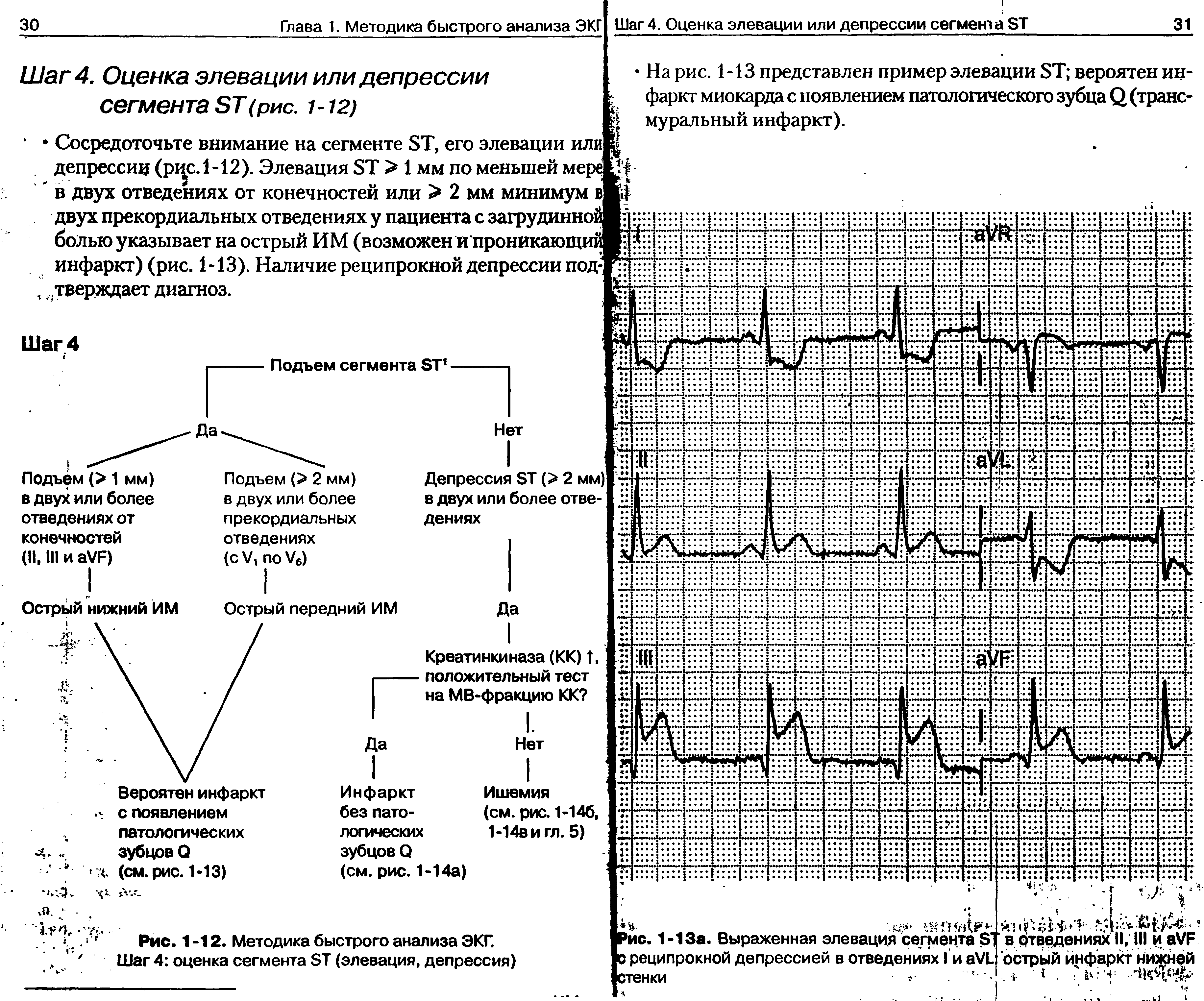 Рис. 1-12. Методика быстрого анализа ЭКГ. Шаг 4 оценка сегмента ЭТ (элевация, депрессия)...