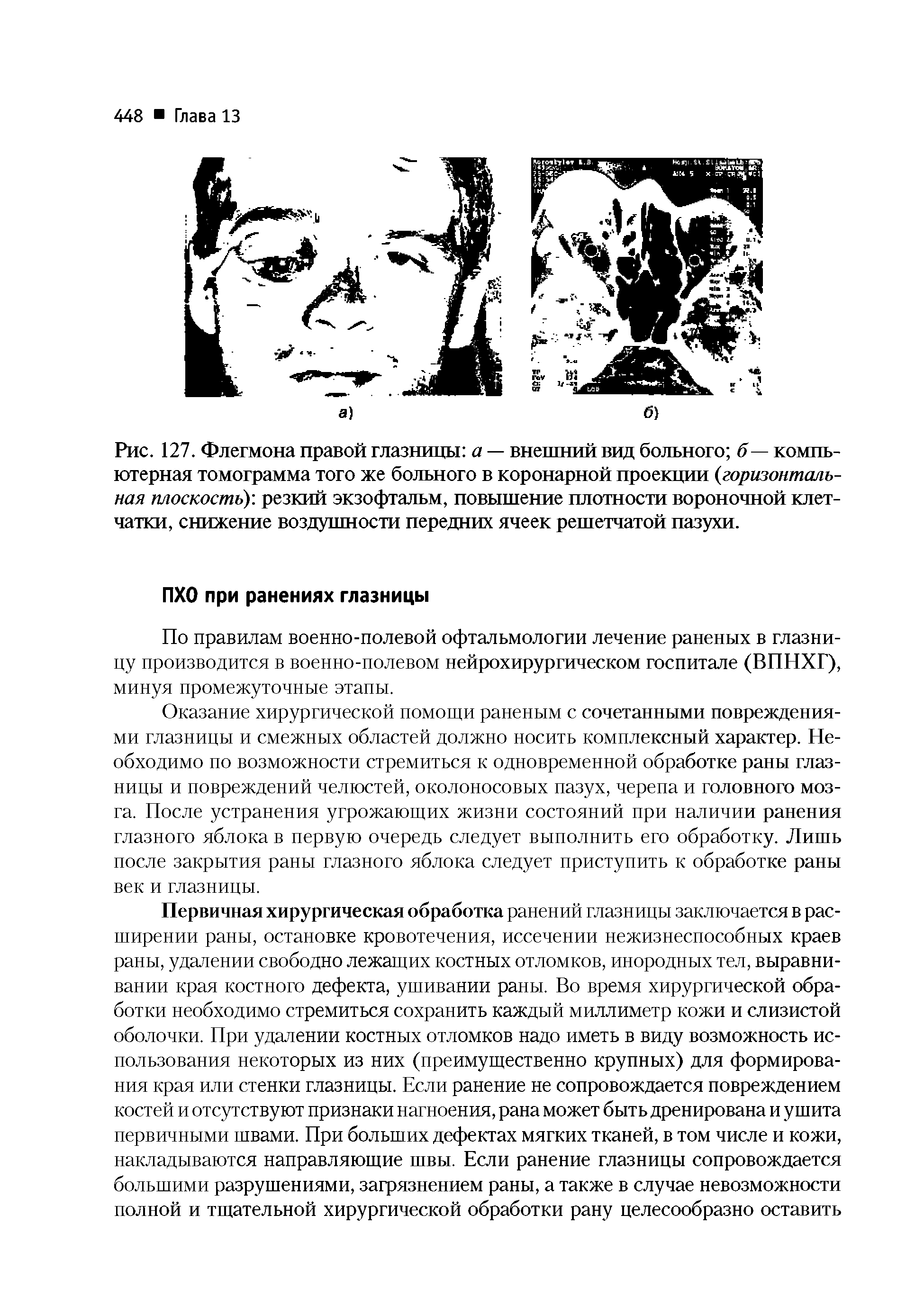 Рис. 127. Флегмона правой глазницы а — внешний вид больного б — компьютерная томограмма того же больного в коронарной проекции горизонтальная плоскость)-, резкий экзофтальм, повышение плотности вороночной клетчатки, снижение воздушности передних ячеек решетчатой пазухи.