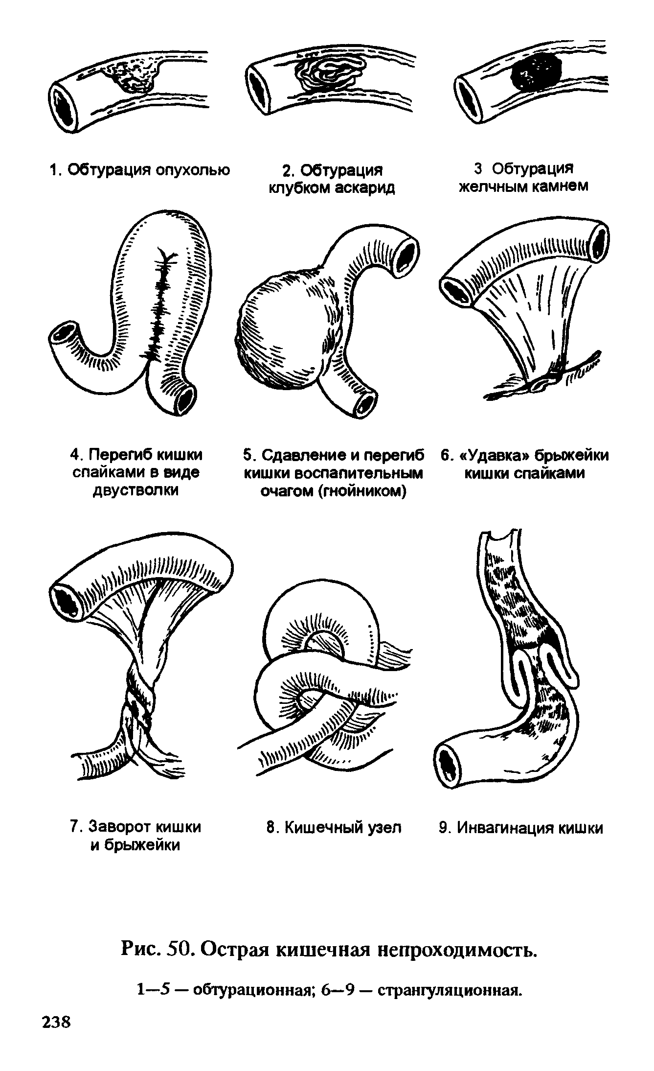 Нарушение проходимости. Формы острой кишечной непроходимости. Острая кишечная непроходимость причины. Классификация обтурационной кишечной непроходимости. Заворот кишечника вид непроходимости.