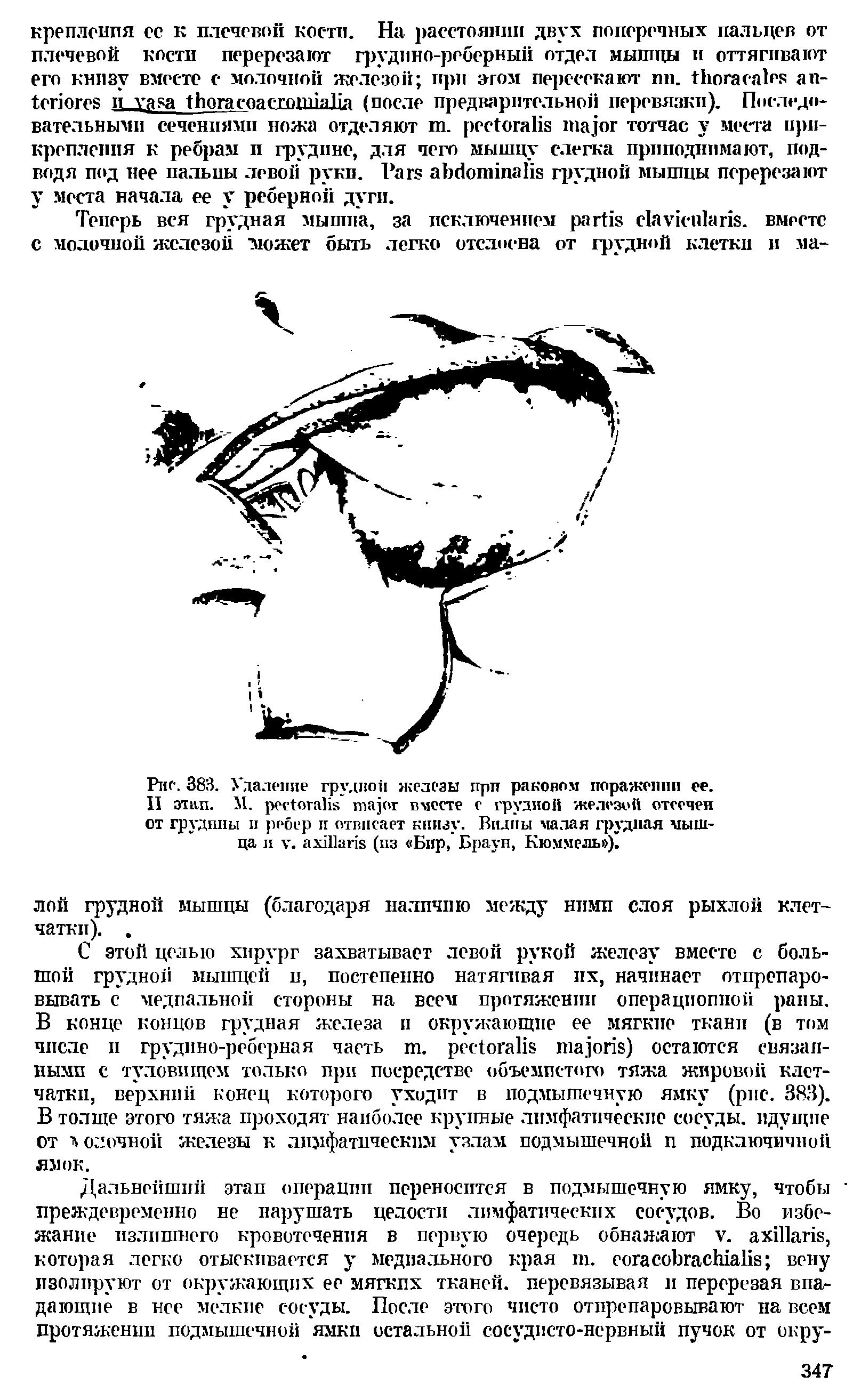 Рис. 383. Удаление грудной железы при раковом поражении ее. II этап. М. вместе с грудной железой отсечен от грудппы и ребер п отвисает книзу. Видны малая грудная мышца л у. (пз Бир, Браун, Кюммель ).