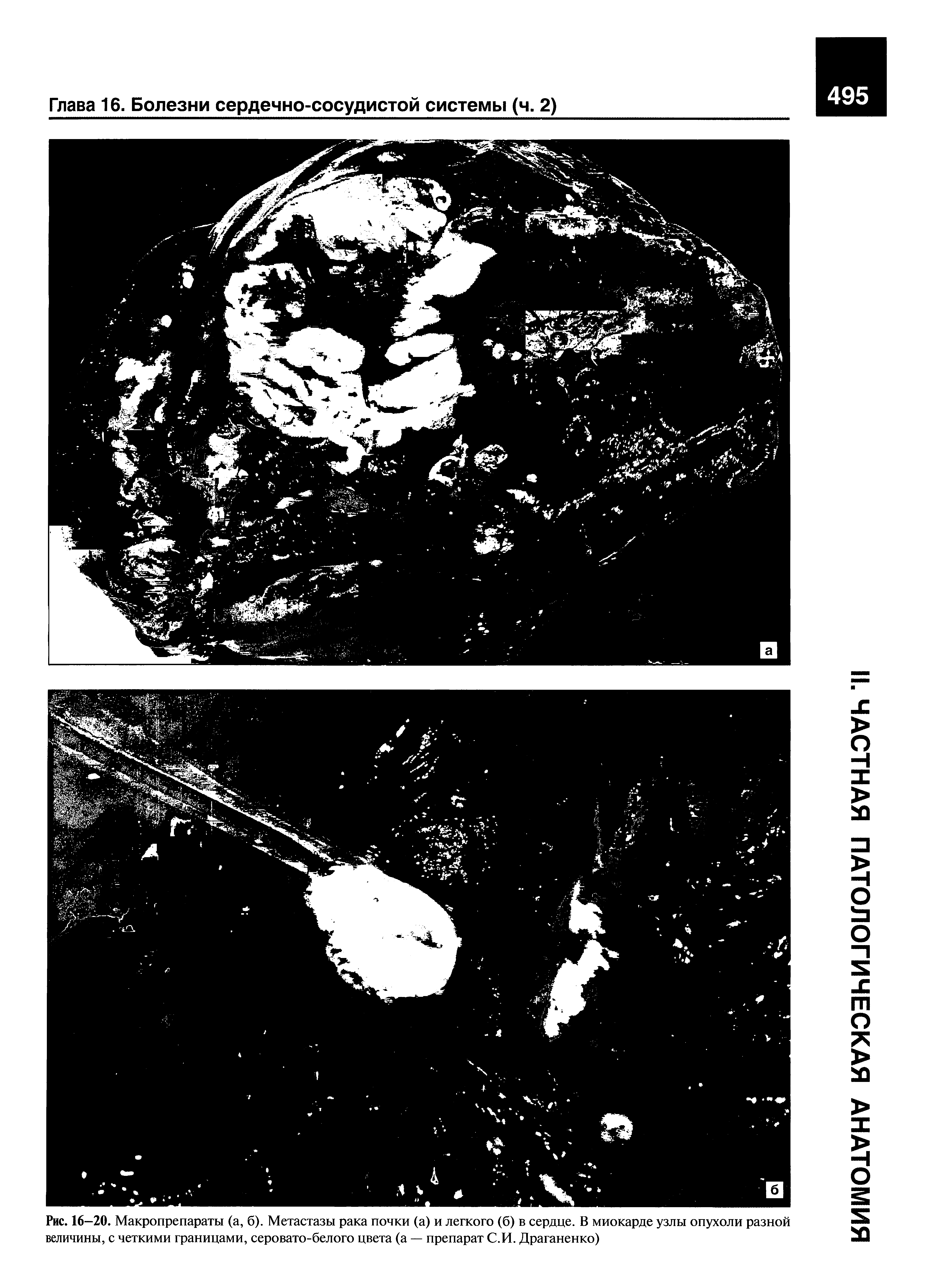 Рис. 16—20. Макропрепараты (а, б). Метастазы рака почки (а) и легкого (б) в сердце. В миокарде узлы опухоли разной величины, с четкими границами, серовато-белого цвета (а — препарат С.И. Драганенко)...