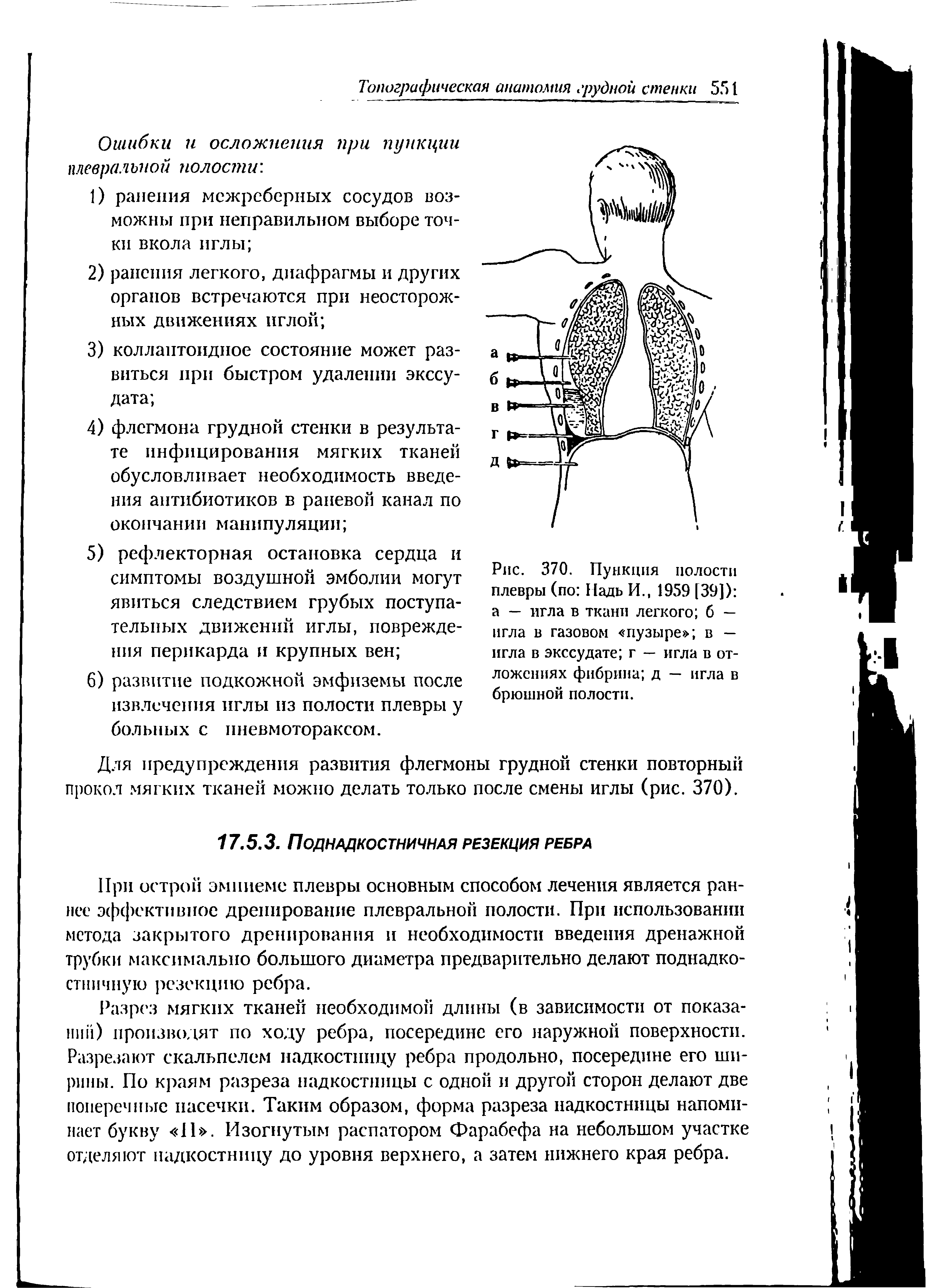 Рис. 370. Пункция полости плевры (по Падь И., 1959 [39]) а — игла в ткани легкого б — игла в газовом пузыре в — игла в экссудате г — игла в отложениях фибрина д — игла в брюшной полости.