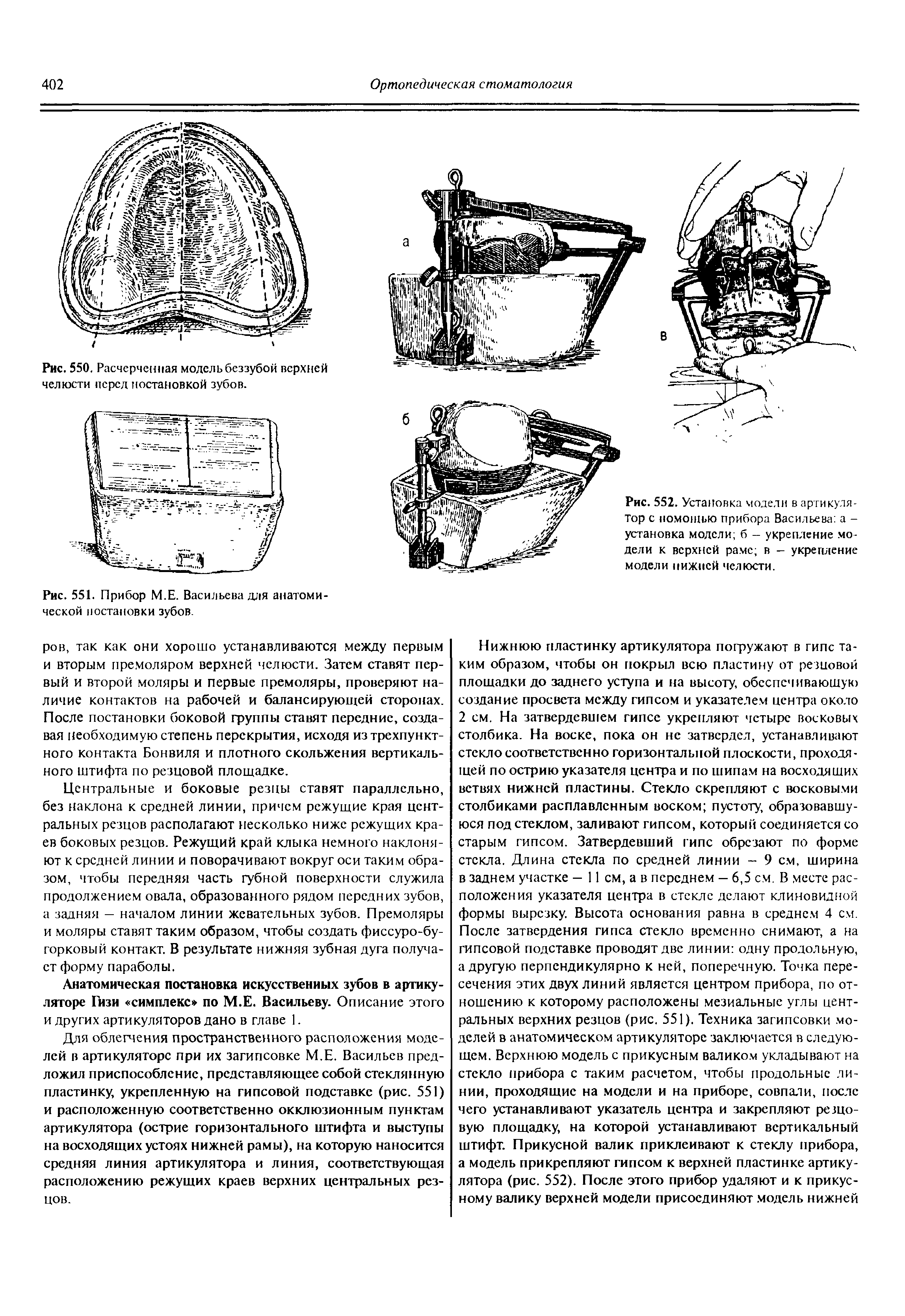 Рис. 552. Установка модели в артикулятор с помощью прибора Васильева а -установка модели б - укрепление модели к верхней рамс в - укрепление модели нижней челюсти.