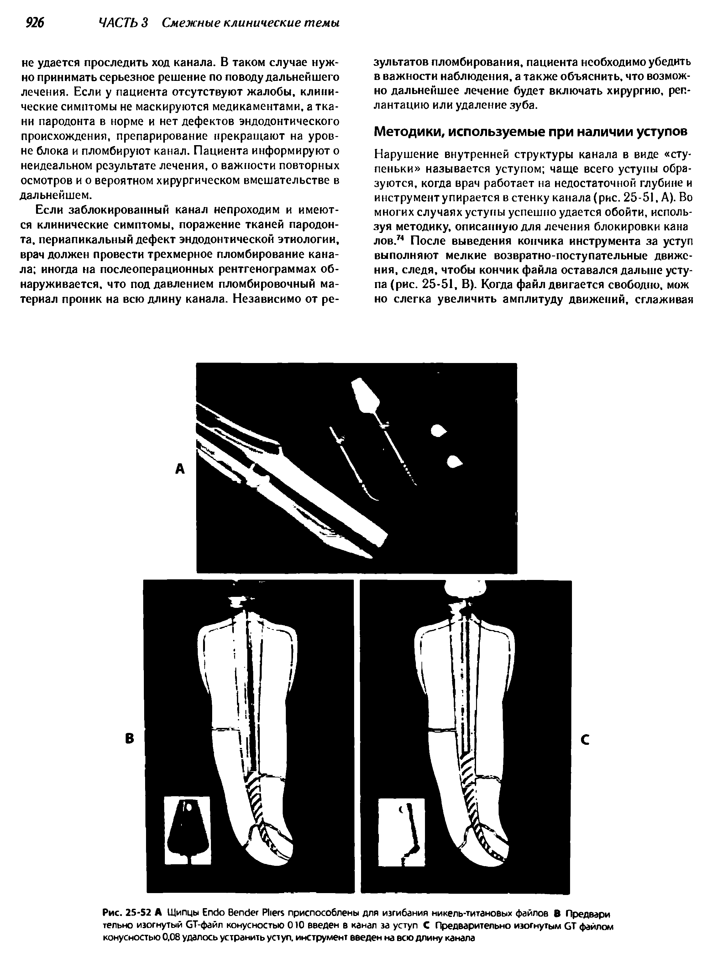 Рис. 25-52 А Щипцы E B P приспособлены для изгибания никель-титановых файлов В Предвари тельно изогнутый GT-файл конусностью 010 введен в канал за уступ С Предварительно изогнутым GT файлом конусностью 0,08 удалось устранить уступ, инструмент введен на всю длину канала...